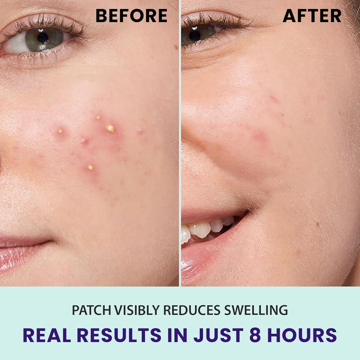 Parche Hidrocólico Invisible 36 Unidades 12mm 4ever Beauty