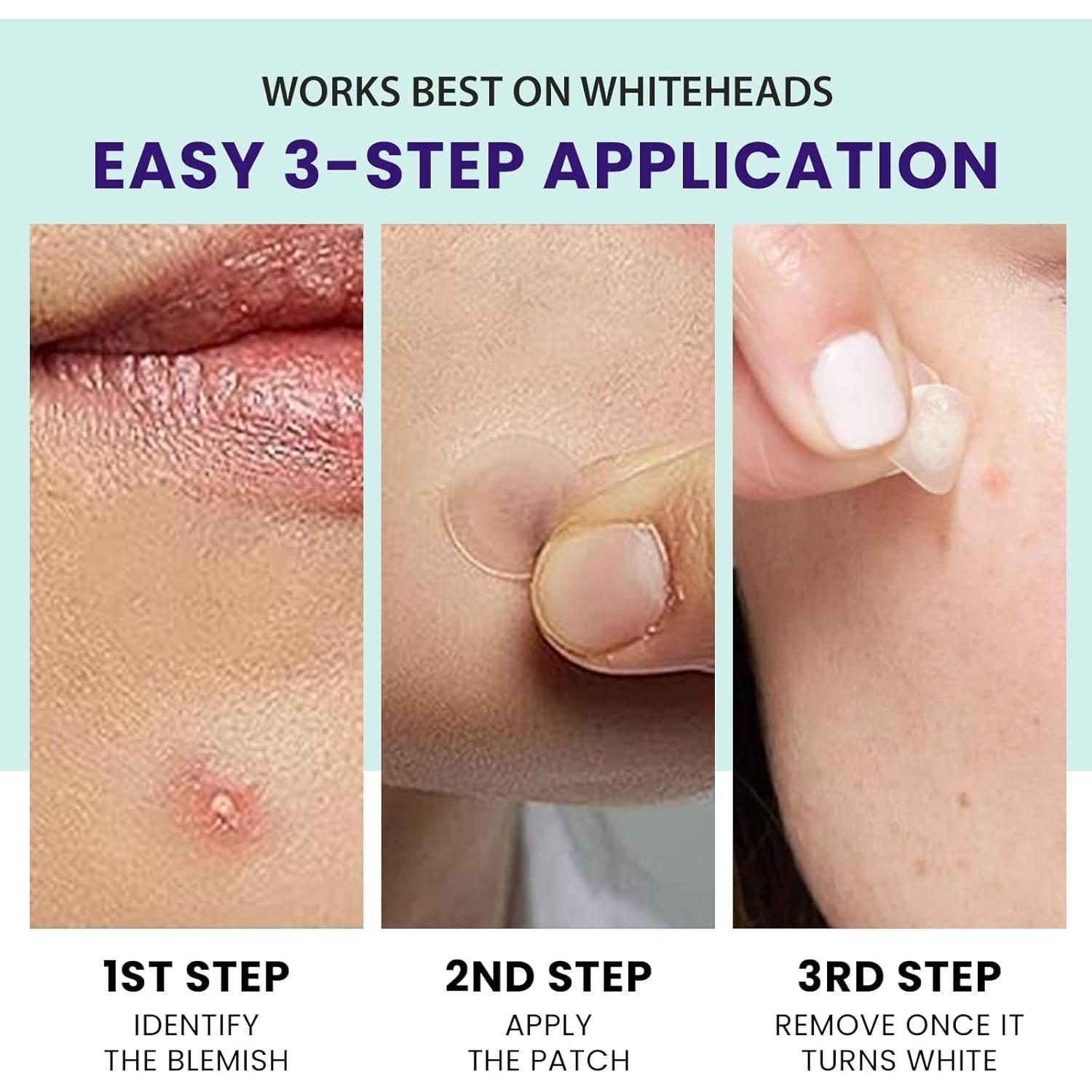 Parche Hidrocólico Invisible 36 Unidades 12mm 4ever Beauty