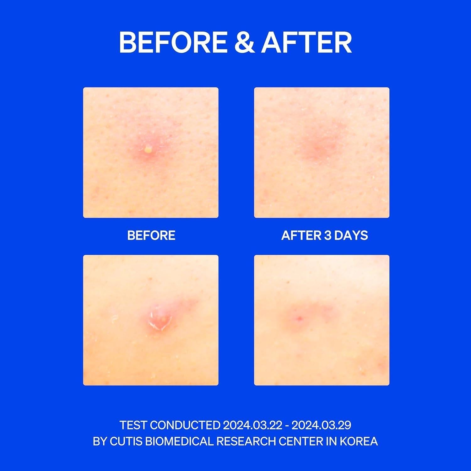 Parche Hidrocoloide Microtip Skin Squared para Granos - 8 Parches