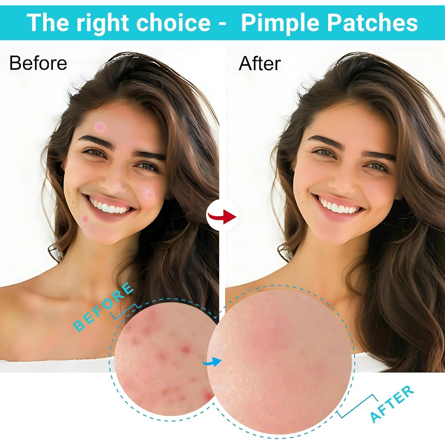 Parche Milagroso Hidrocoloide para Granitos - 96 Unidades