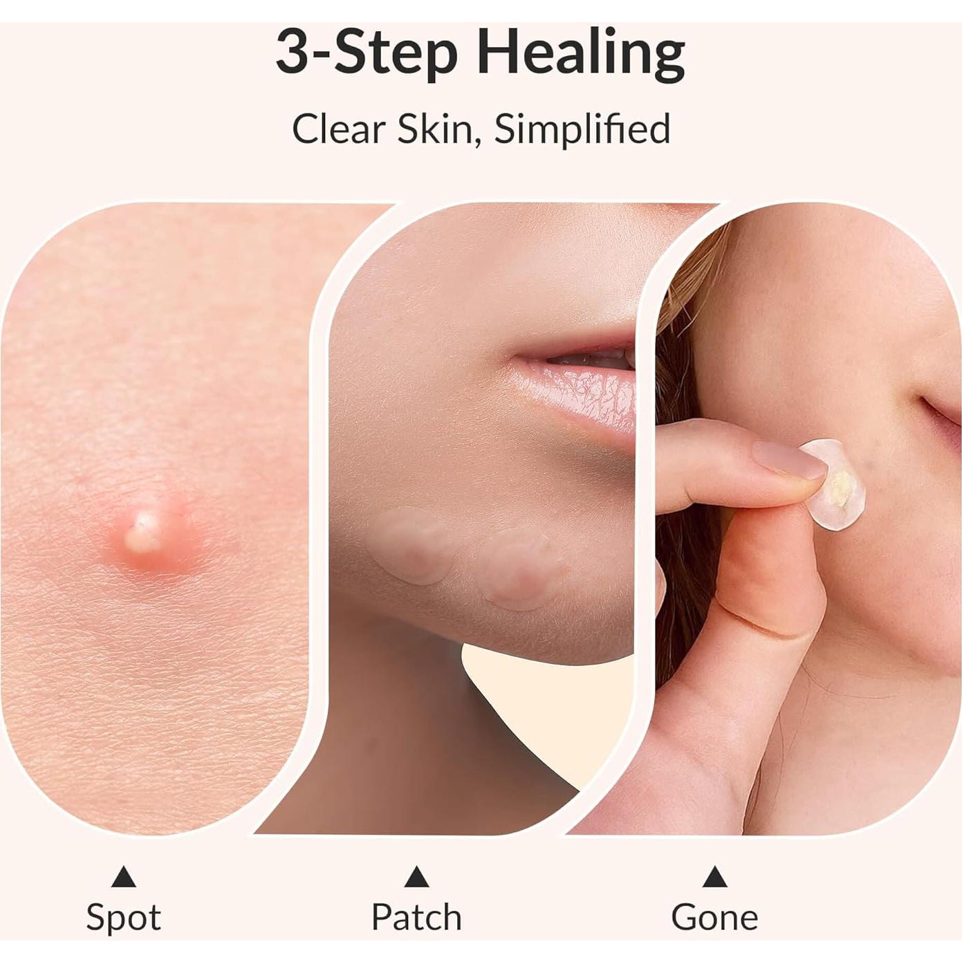 Parche Hidrocoloide RPE Life para Acné - 144 Unidades