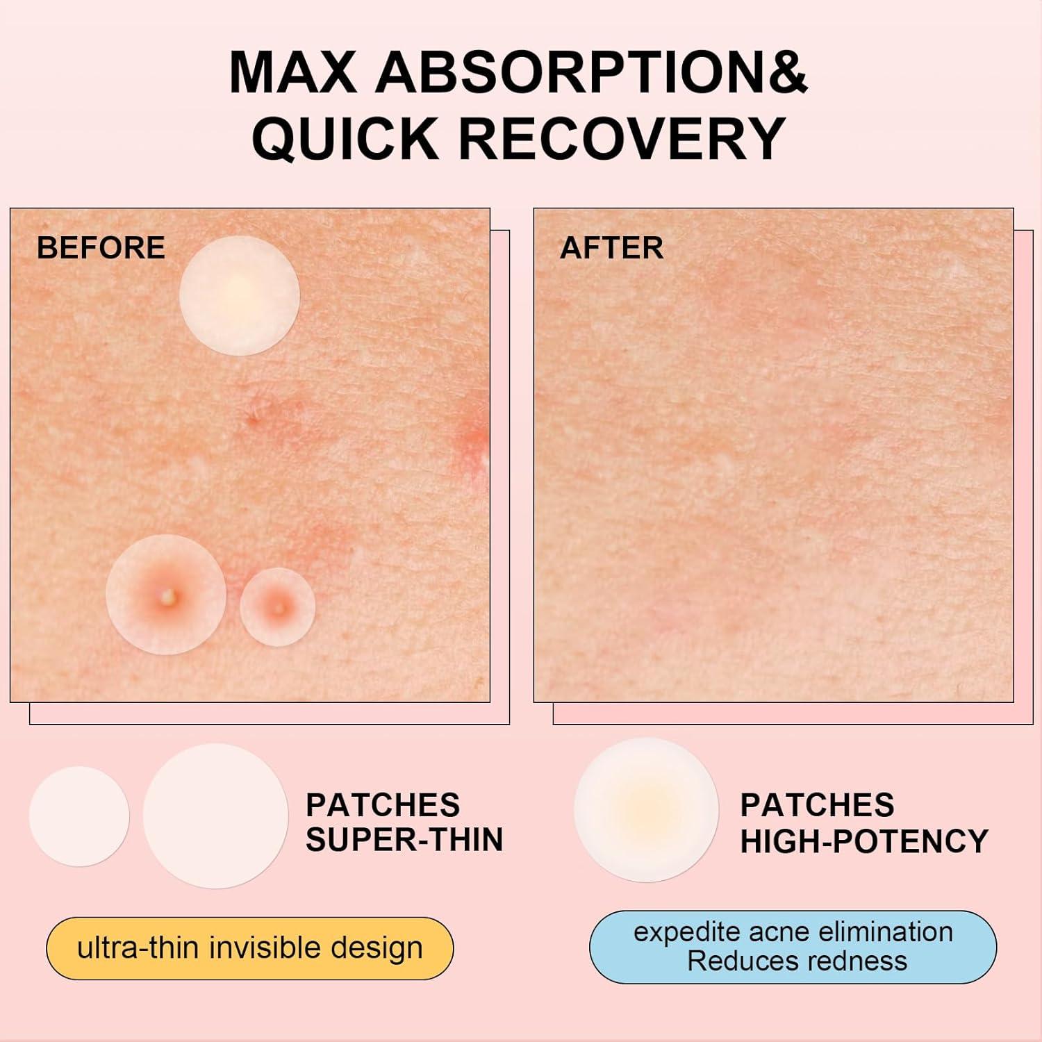 Parches para Granos AVJONE - 144 Parches Hidrocoloides con Aceite de Árbol de Té