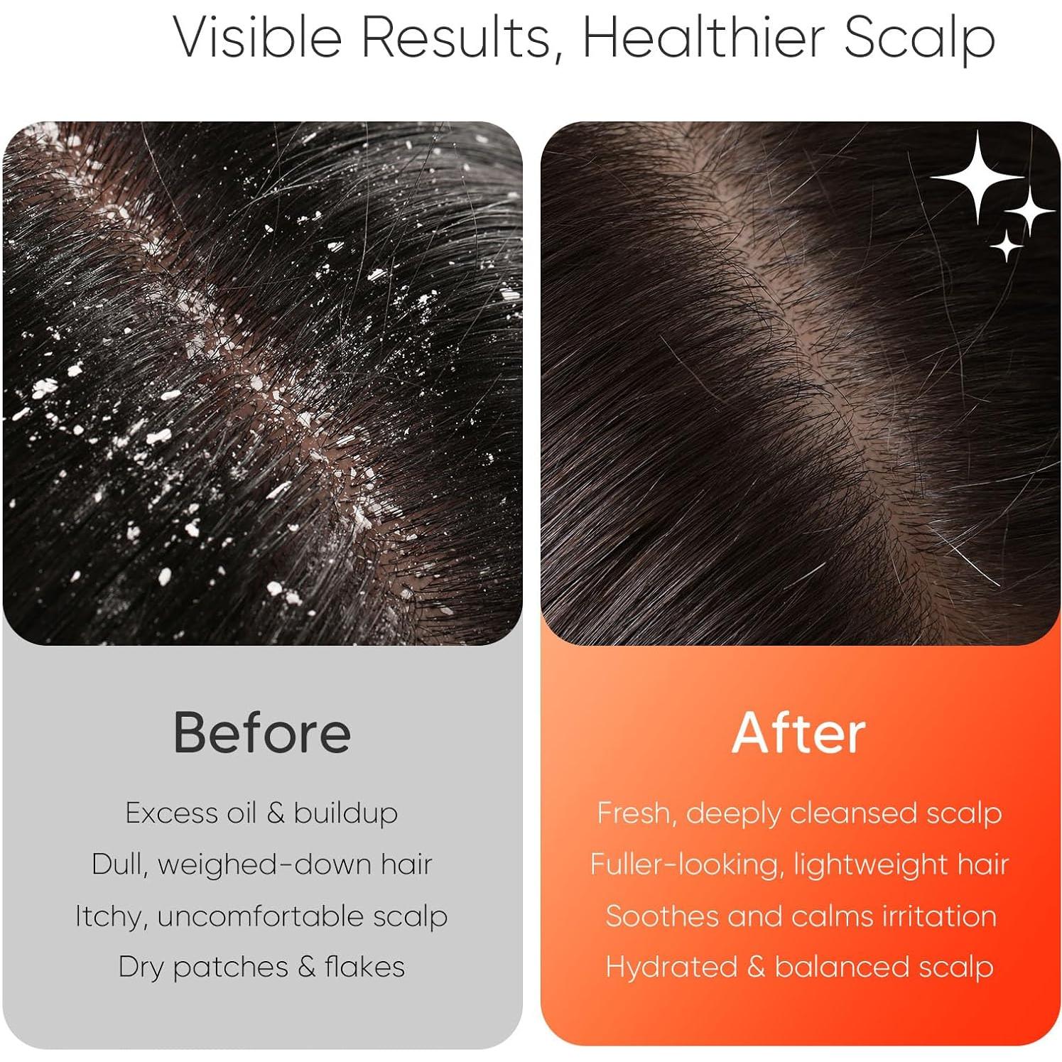 Cepillo de Masaje Eléctrico EKZ para Cuero Cabelludo - Silicona