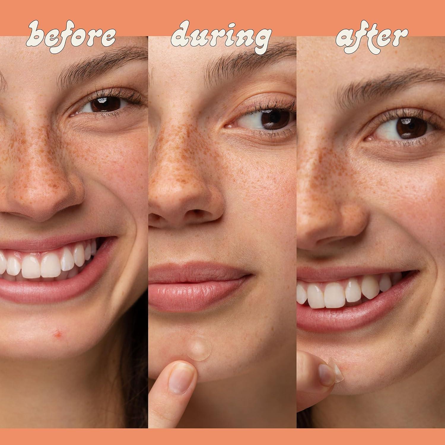 Parches Hidrocoloides para Granos LeSpot - 38 Unidades