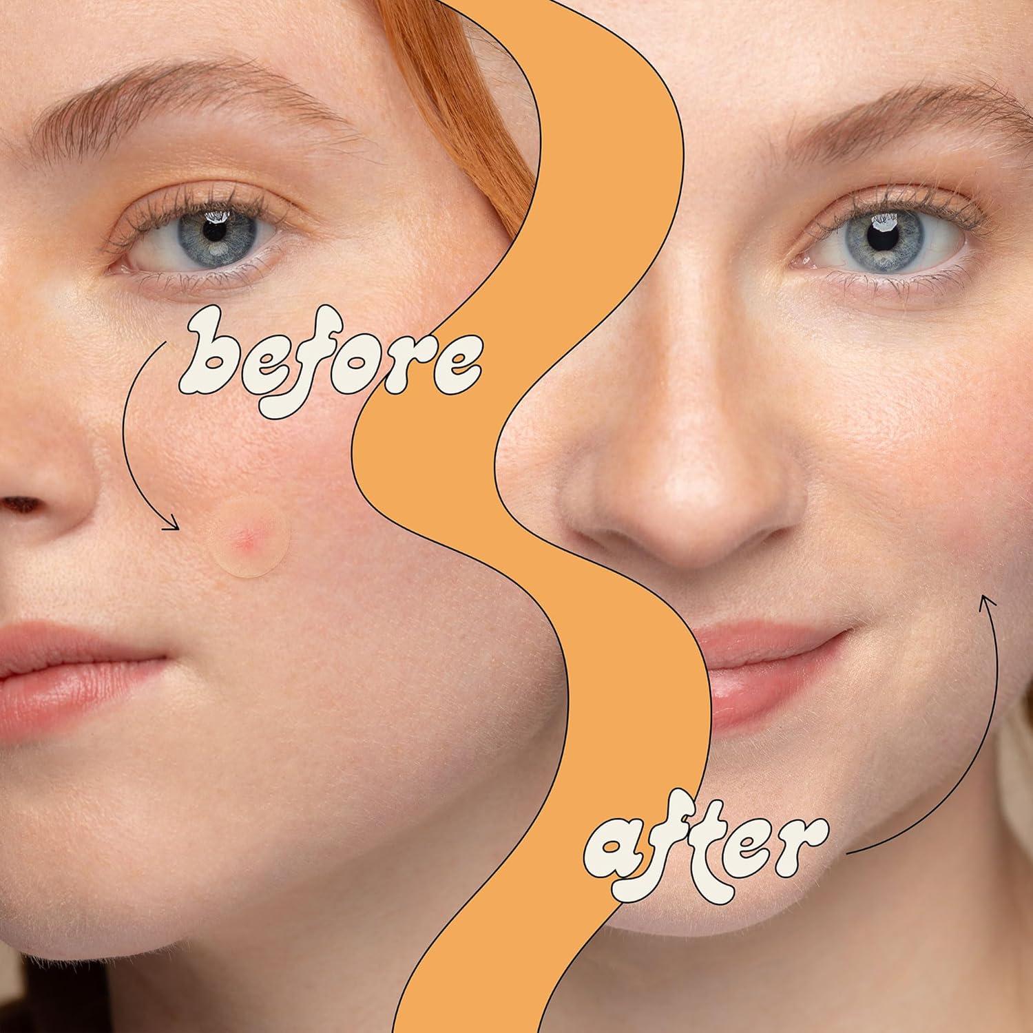 Parches Hidrocoloides para Granos LeSpot - 38 Unidades