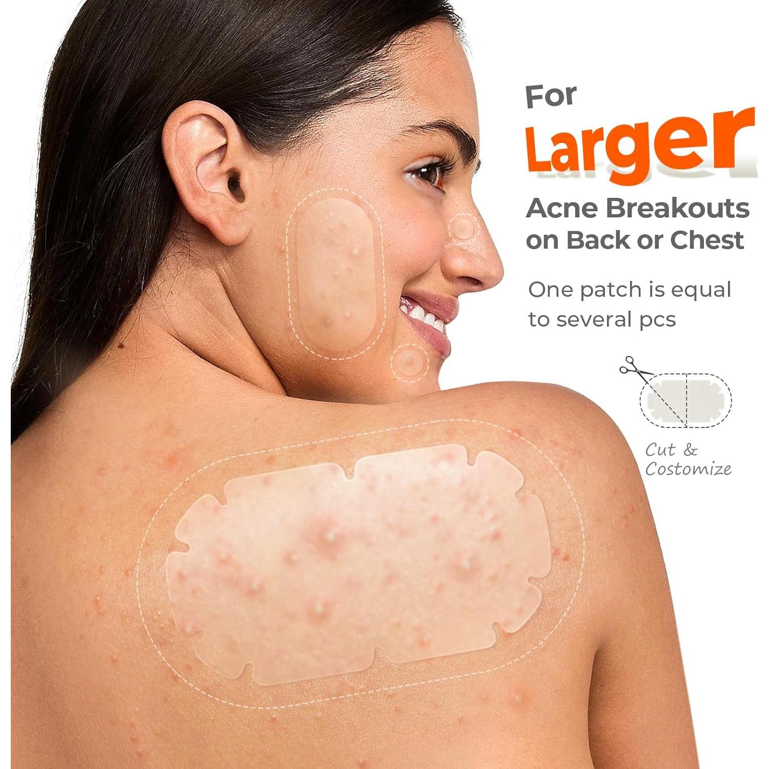 Parches para Acné Corporal TKTK XXL - 110 Piezas Hidrocoloide