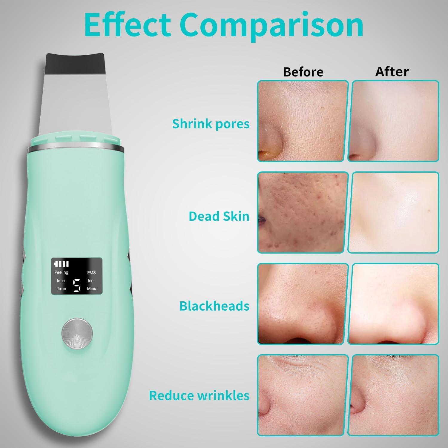 Espátula Facial Skin Scrubber QYCSL 4 en 1 Cuidado Piel Verde