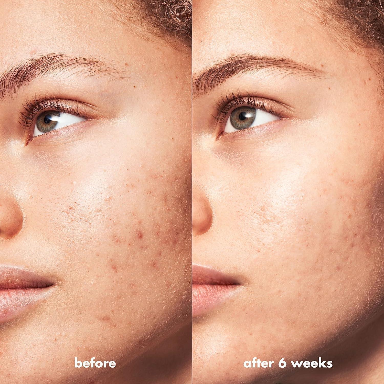 Suero Nocturno e.l.f. SKIN Triple Ácido 8.5% 108g