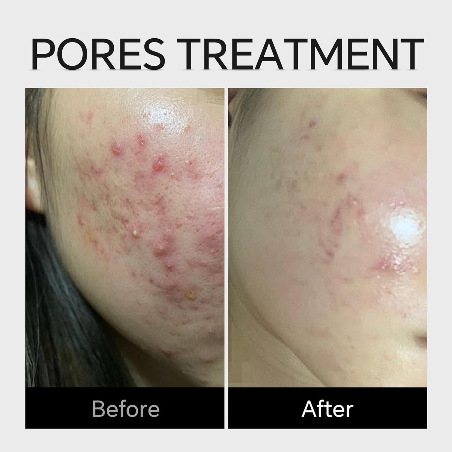 Crema de Suero de Ácido Azelaico 10% Apatock 45g - Tratamiento Acné y Rosácea