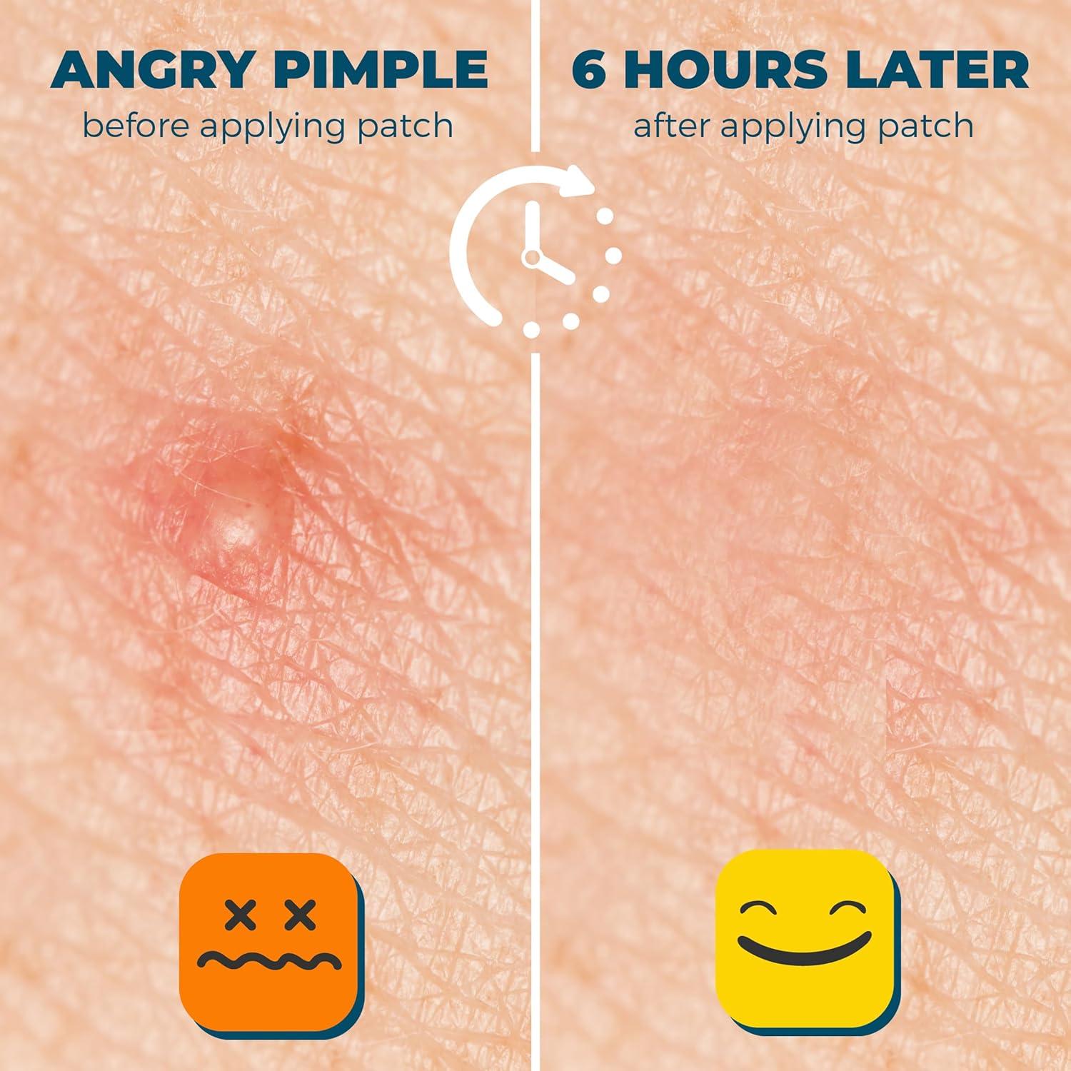 Parches para Granos de Acné Dermadot - Hidrocoloides 300 Unidades