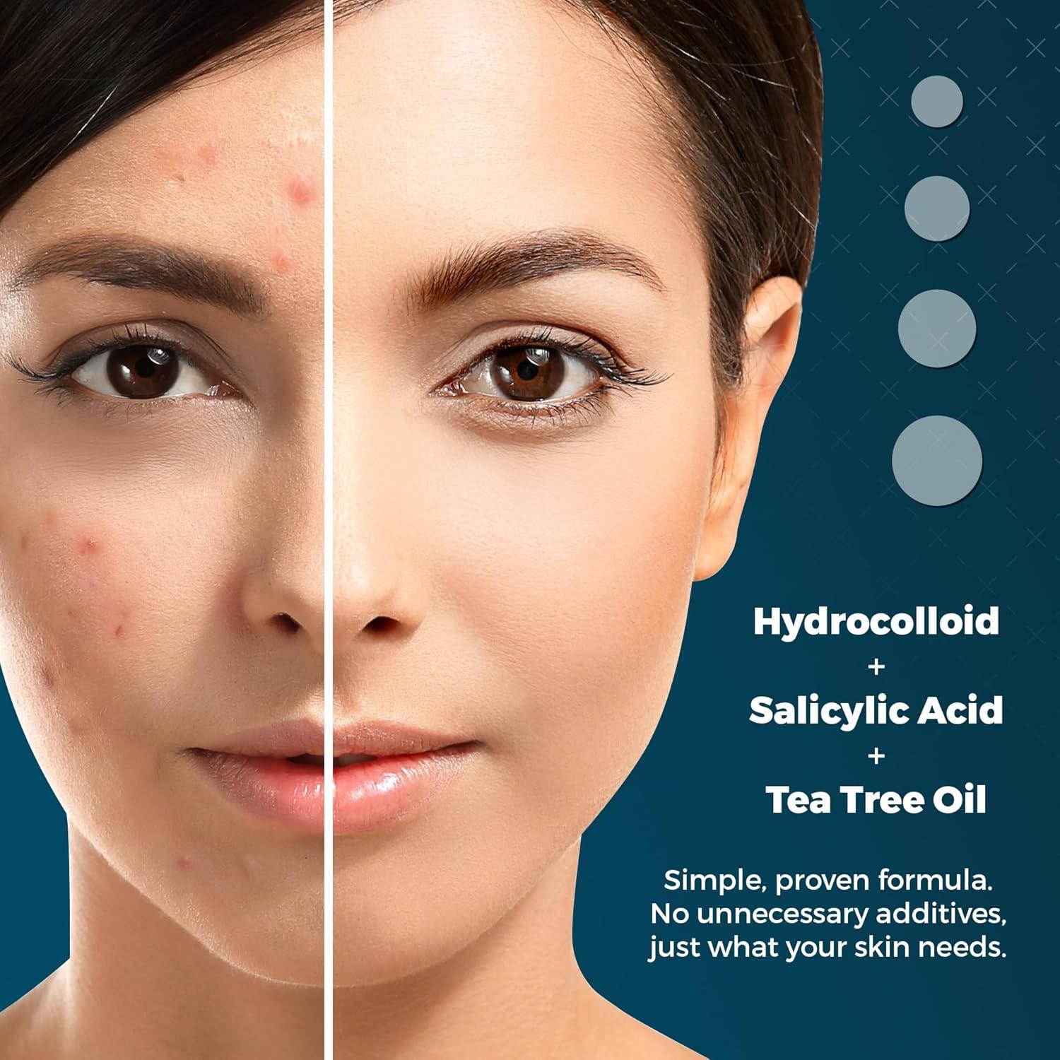 Parches para Granos de Acné Dermadot - Hidrocoloides 300 Unidades