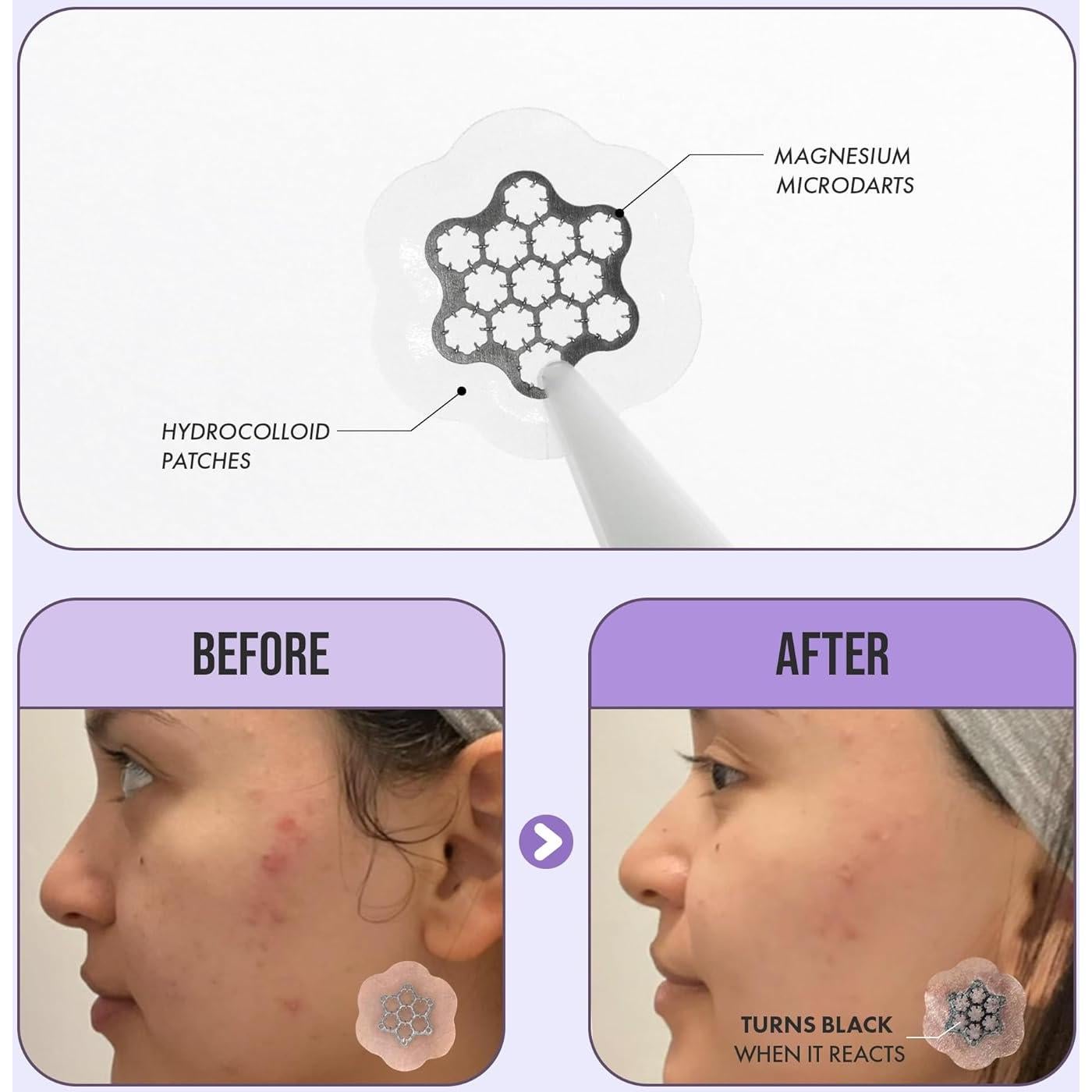 Microagujas para Acné LAFLARE 6 Piezas - Acción Rápida