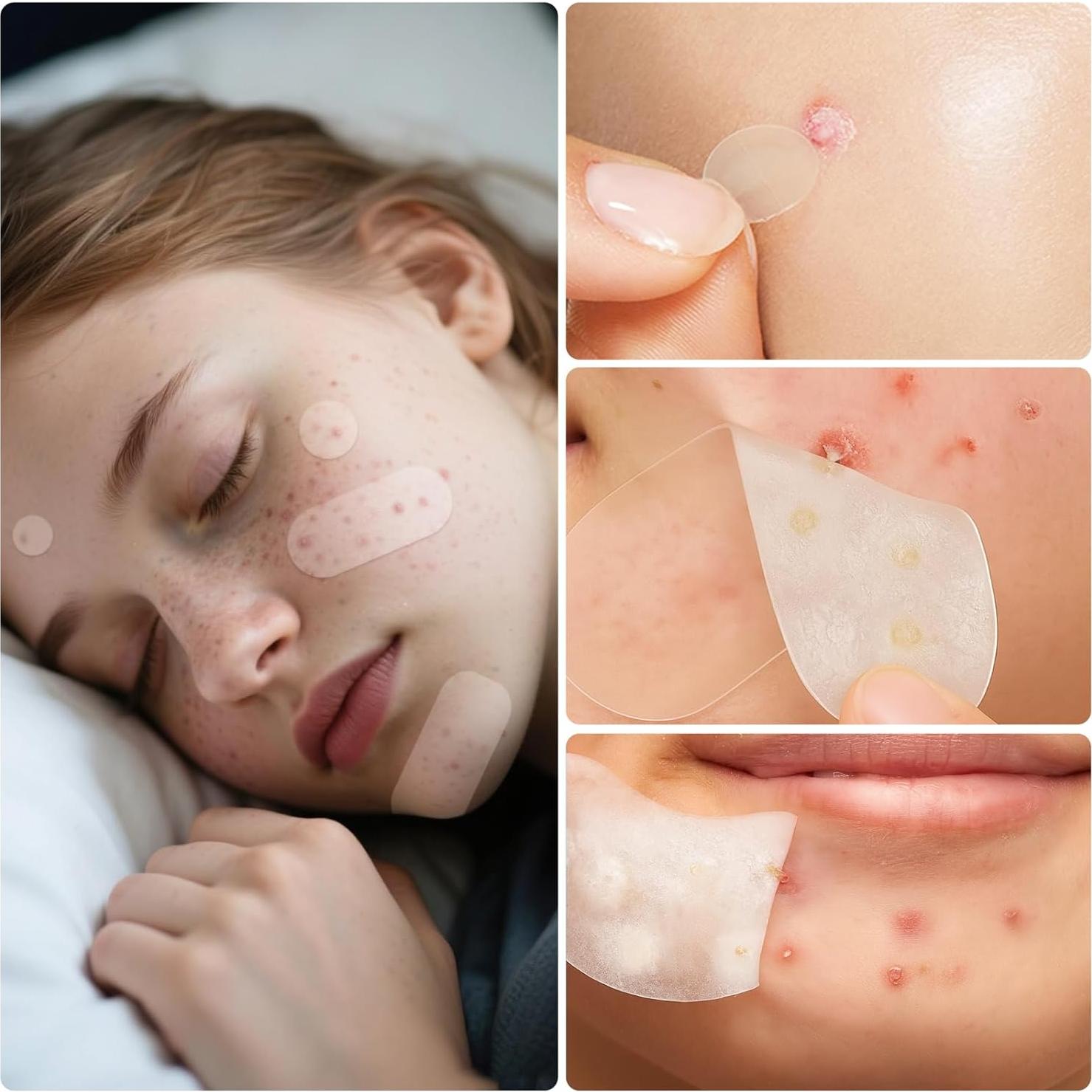 Parche Hidrocoloide para Granos JOLVKA - 368 Unidades, 5 Tamaños