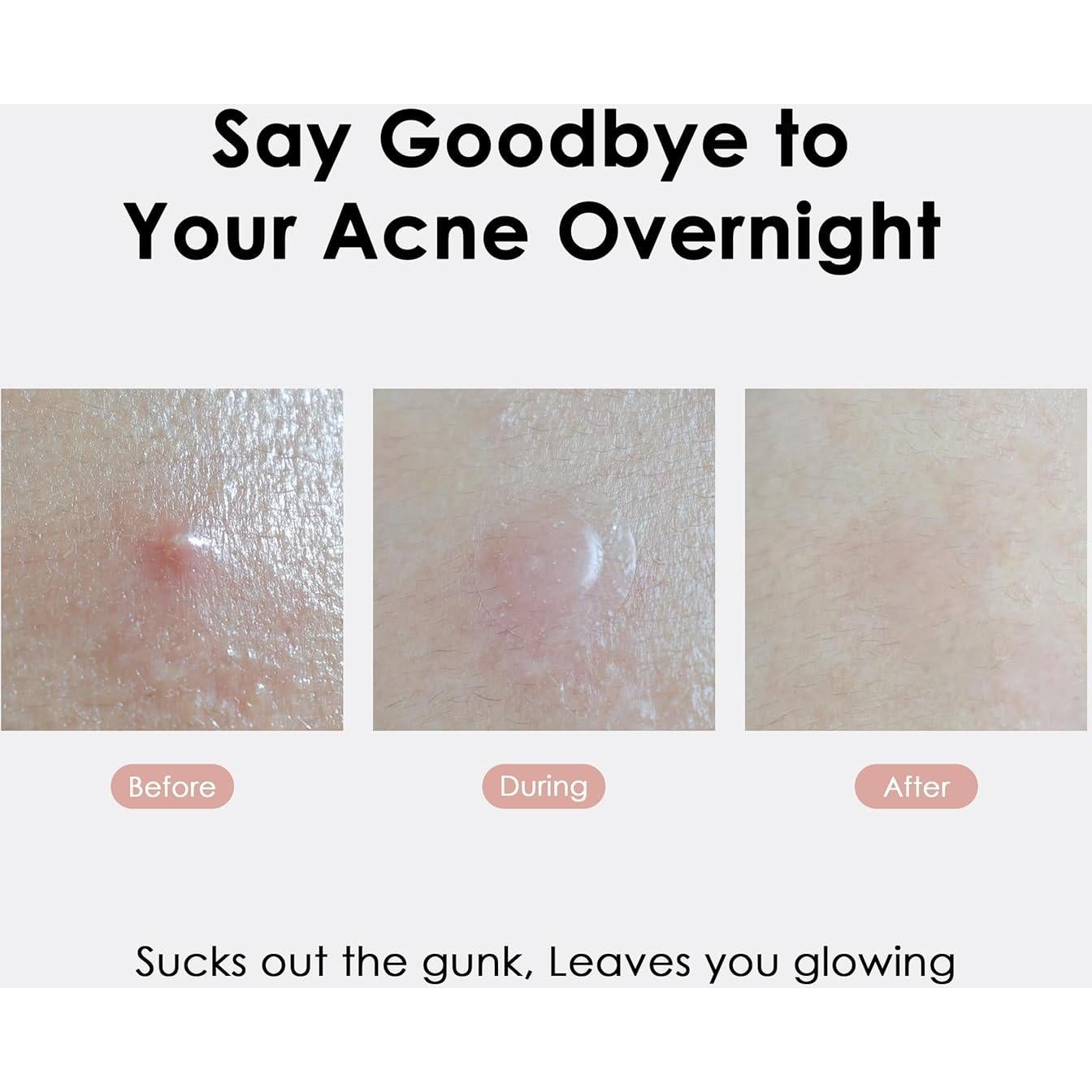 Parche Aliviador de Manchas Activas ASAP - 39 Parches Hidrocoloide