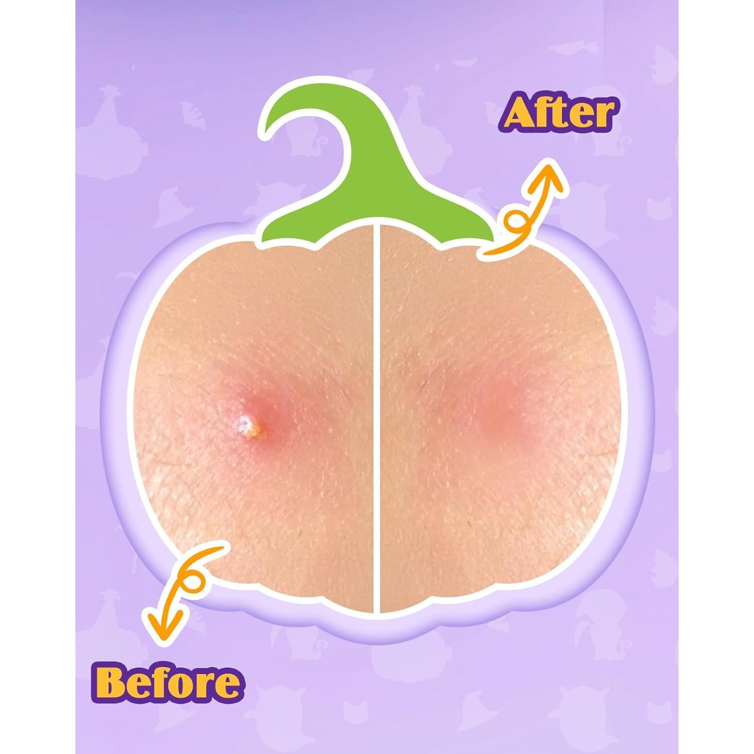 Parches Hidrocoloides para Acné Attyxfica Halloween - 144 Parches