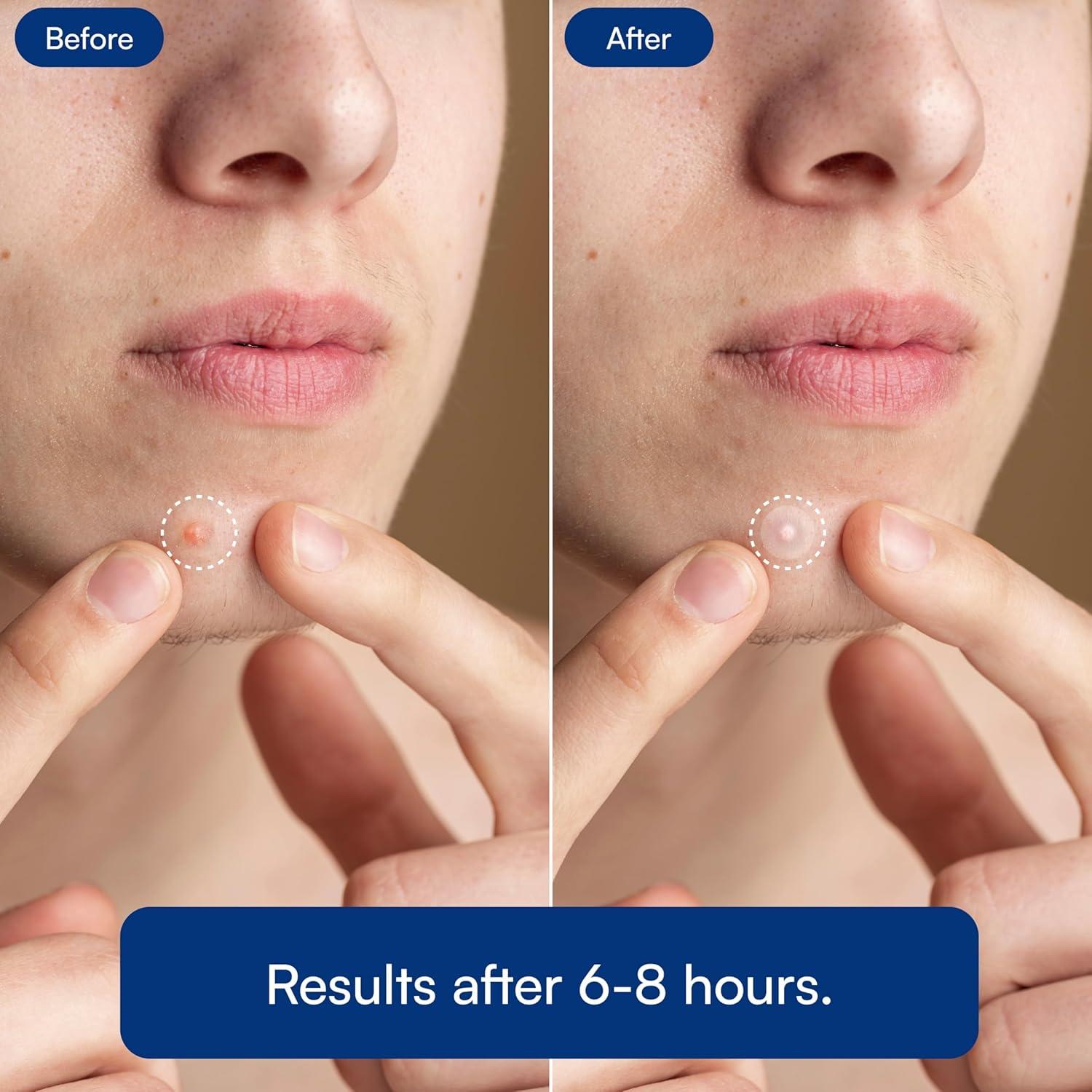 Parche Hidrocoloide Chel's Cosmetic para Acné - 66 Unidades