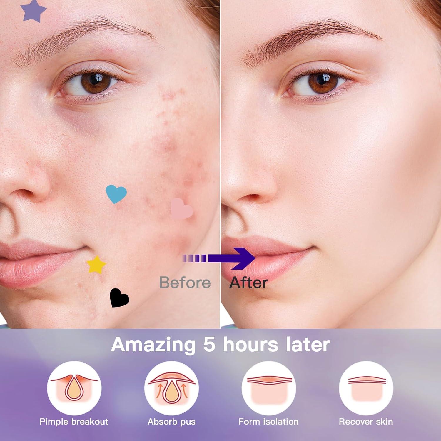 Parches para Acné Hidrocoloide 312CT - Ácido Salicílico, 5 Tamaños, 6 Colores