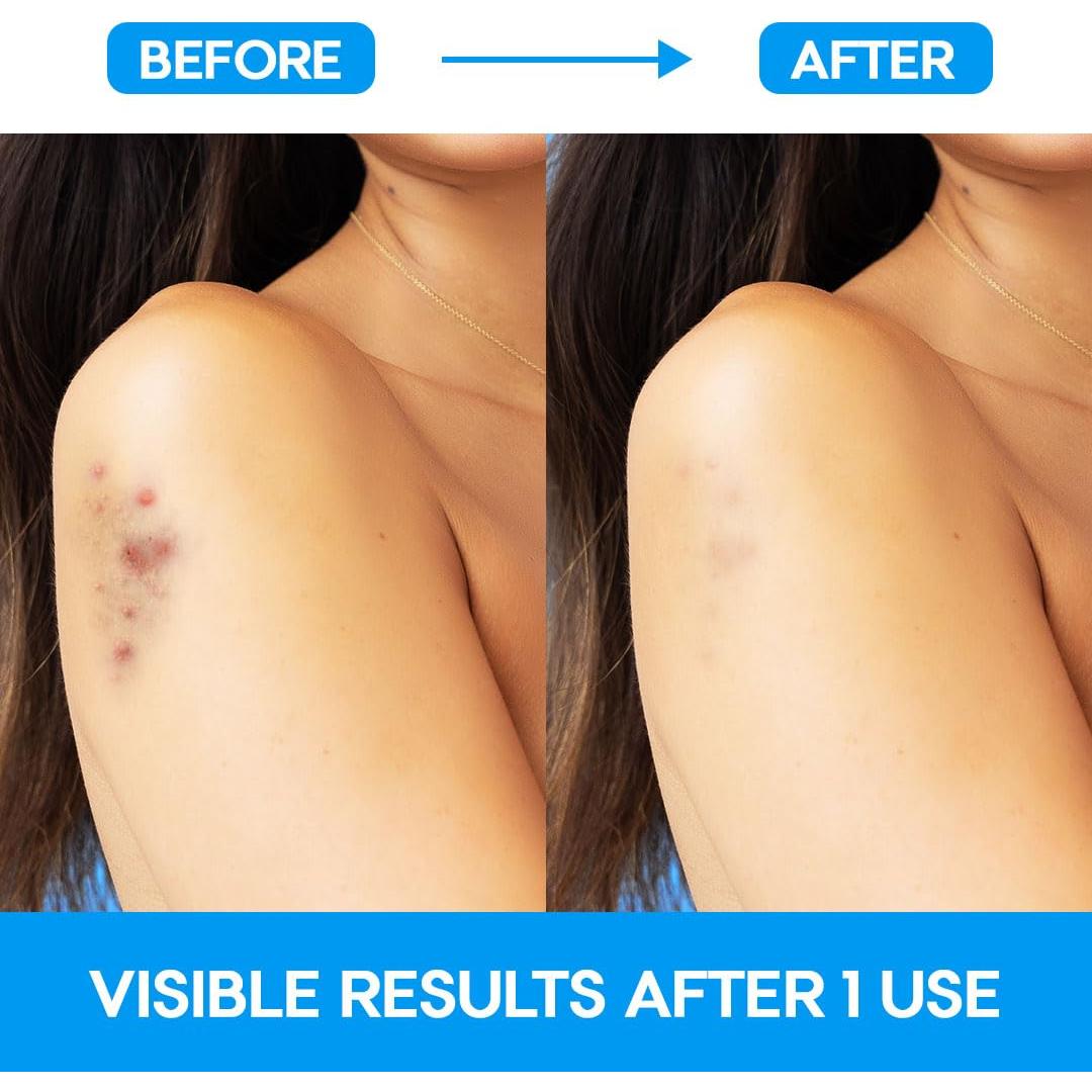 Parches para Granos Extra Grandes EZACNE - Hidrocoloide Médico (5 Unidades)