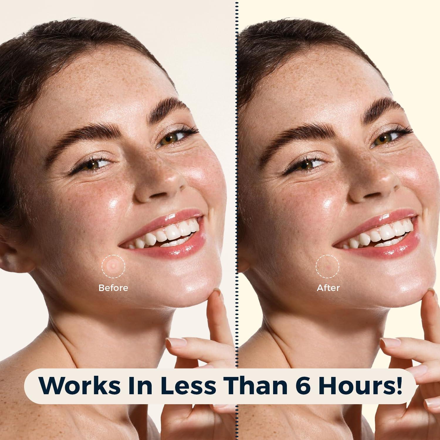 Parche Hidrocoloide para Granos Havenique - 324 Unidades