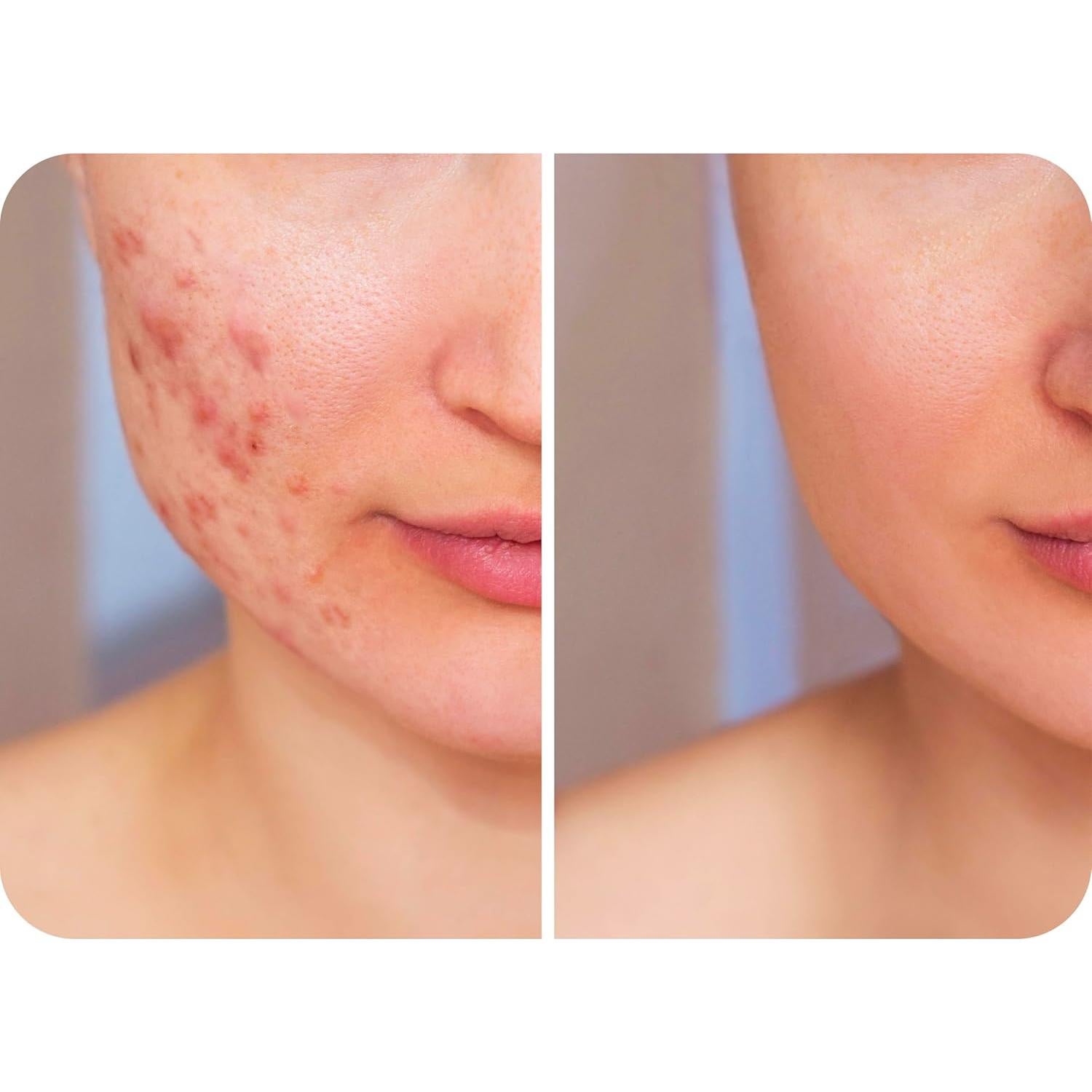 Spray de Ácido Hipocloroso HypoClear 227 g - Limpiador Facial Suave