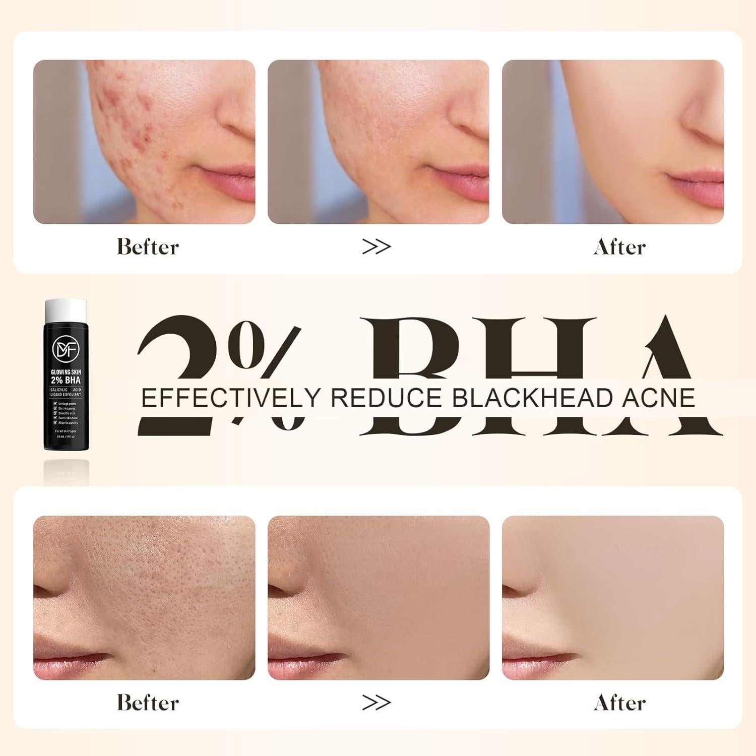 Suero Exfoliante Líquido Ácido Salicílico 2% 118 mL - Anti-Acné