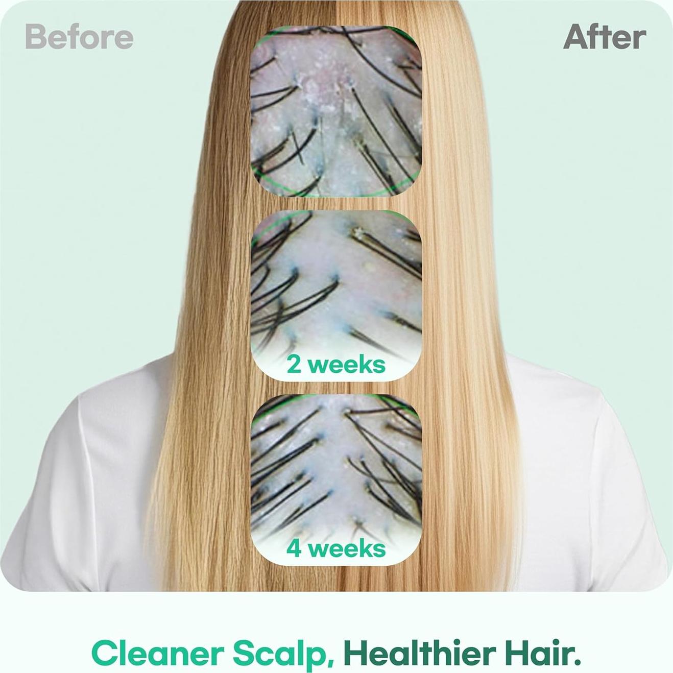 Champú Anticaspa Coreano COSMECCA 400 ml para Adolescentes