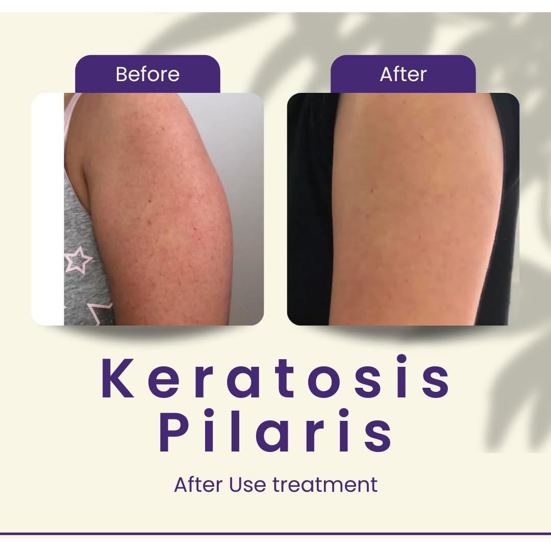 Crema Exfoliante KP Areton 50g - Ácido Salicilico y Niacinamida