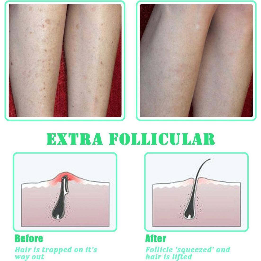 Cepillo Exfoliante TailaiMei para Vello Encarnado y Bultos
