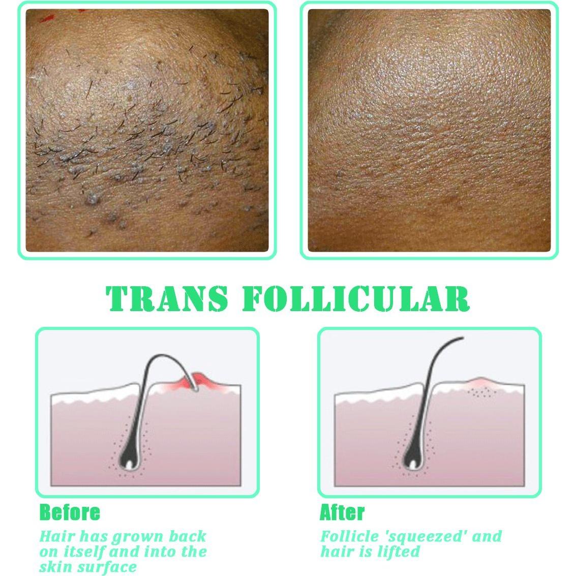 Cepillo Exfoliante TailaiMei para Vello Encarnado y Bultos