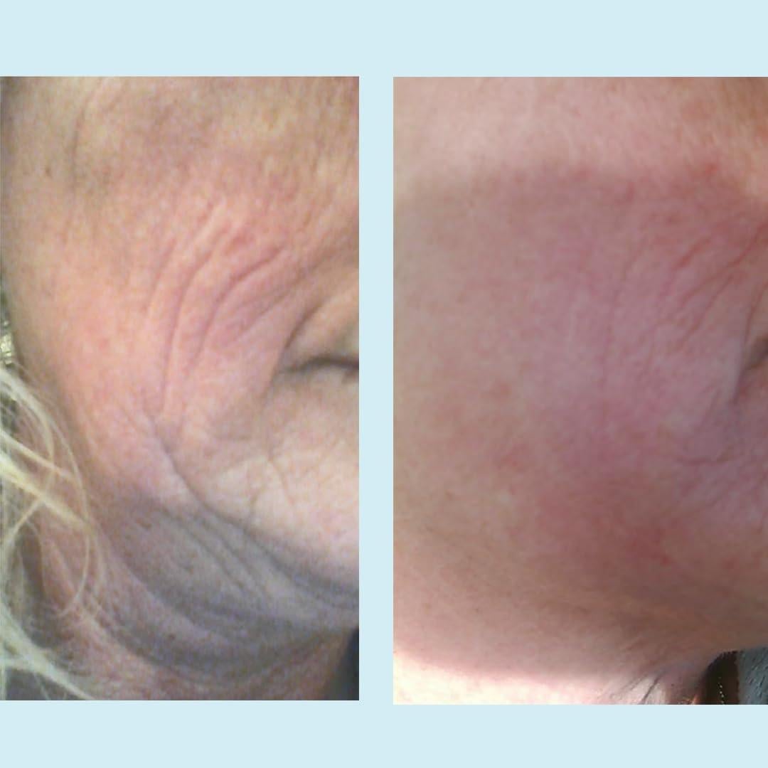 Peeling Químico Lactic 50% Imagen Perfecta 30 mL - Exfoliante Facial