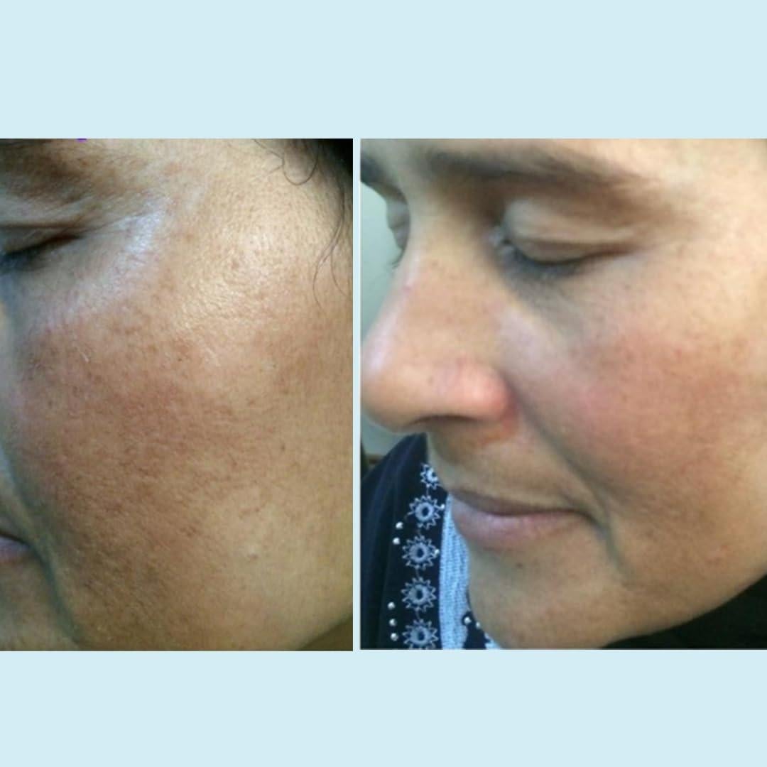 Peeling Químico Lactic 50% Imagen Perfecta 30 mL - Exfoliante Facial