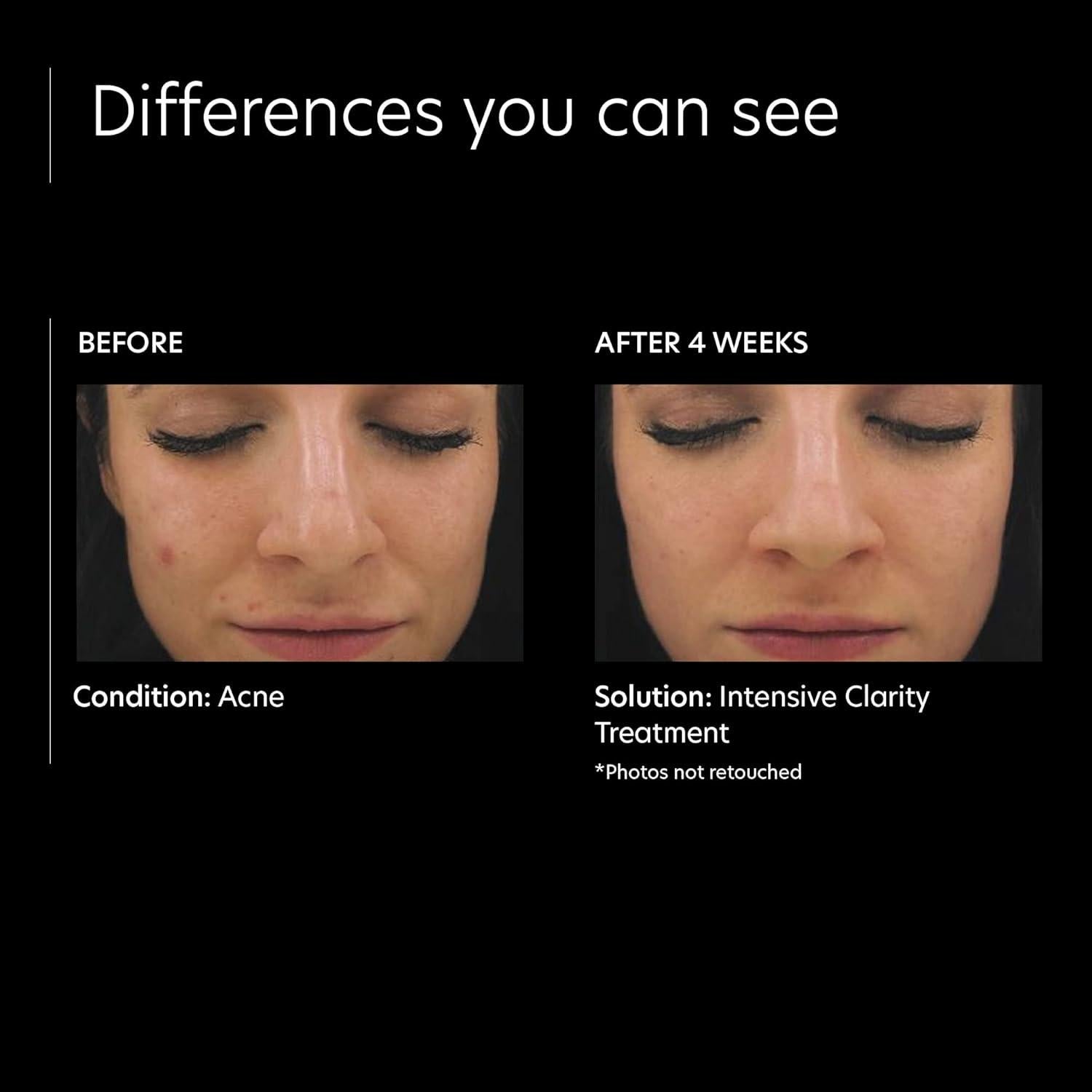 Suero Facial PCA SKIN 0.5% Retinol y 2% Ácido Salicílico 28.35g