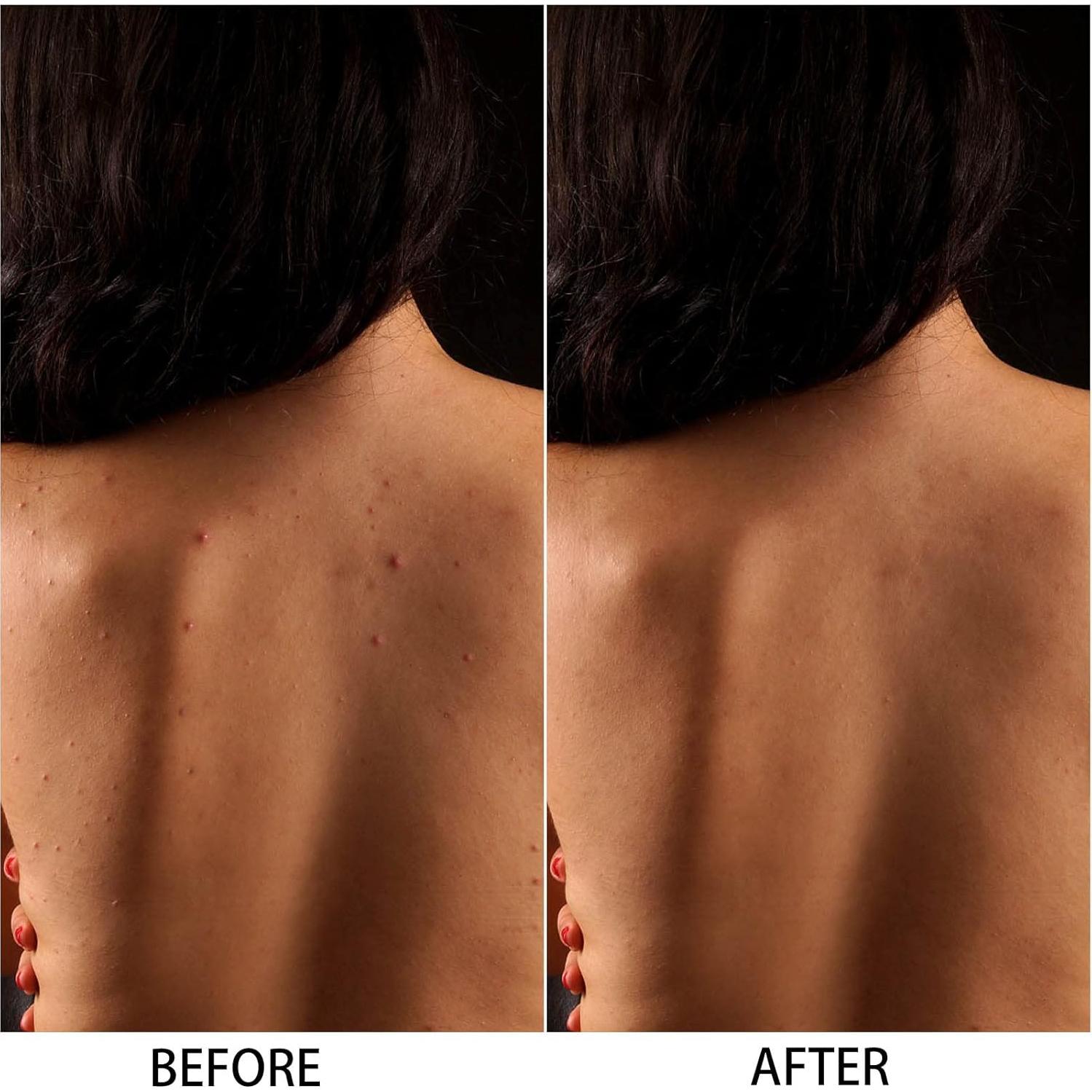 Esponja de Baño Exfoliante Ohlove 20x65cm Nylon para Espalda