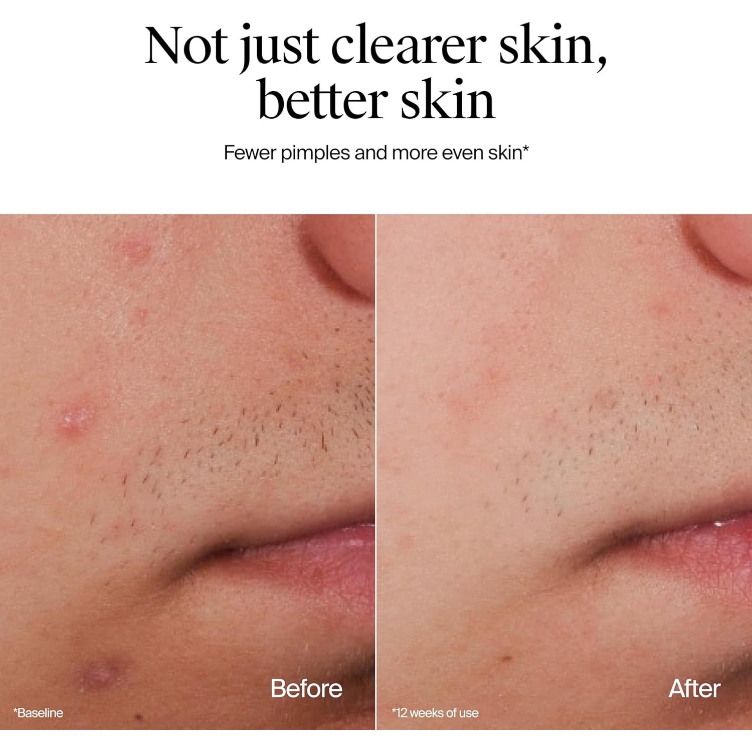 Limpiador Facial Sin Aceite Neutrogena 269 ml - Acné 2% Ácido Salicílico