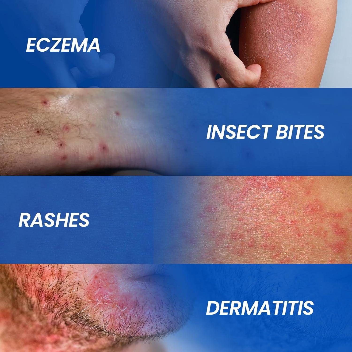 Crema Hidrocortisona 1% Avedana 28.35g con Aloe Vera