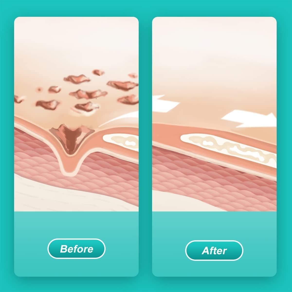 Dimora Hidrogel 2 Paquetes 170g Crema para Quemaduras y Heridas