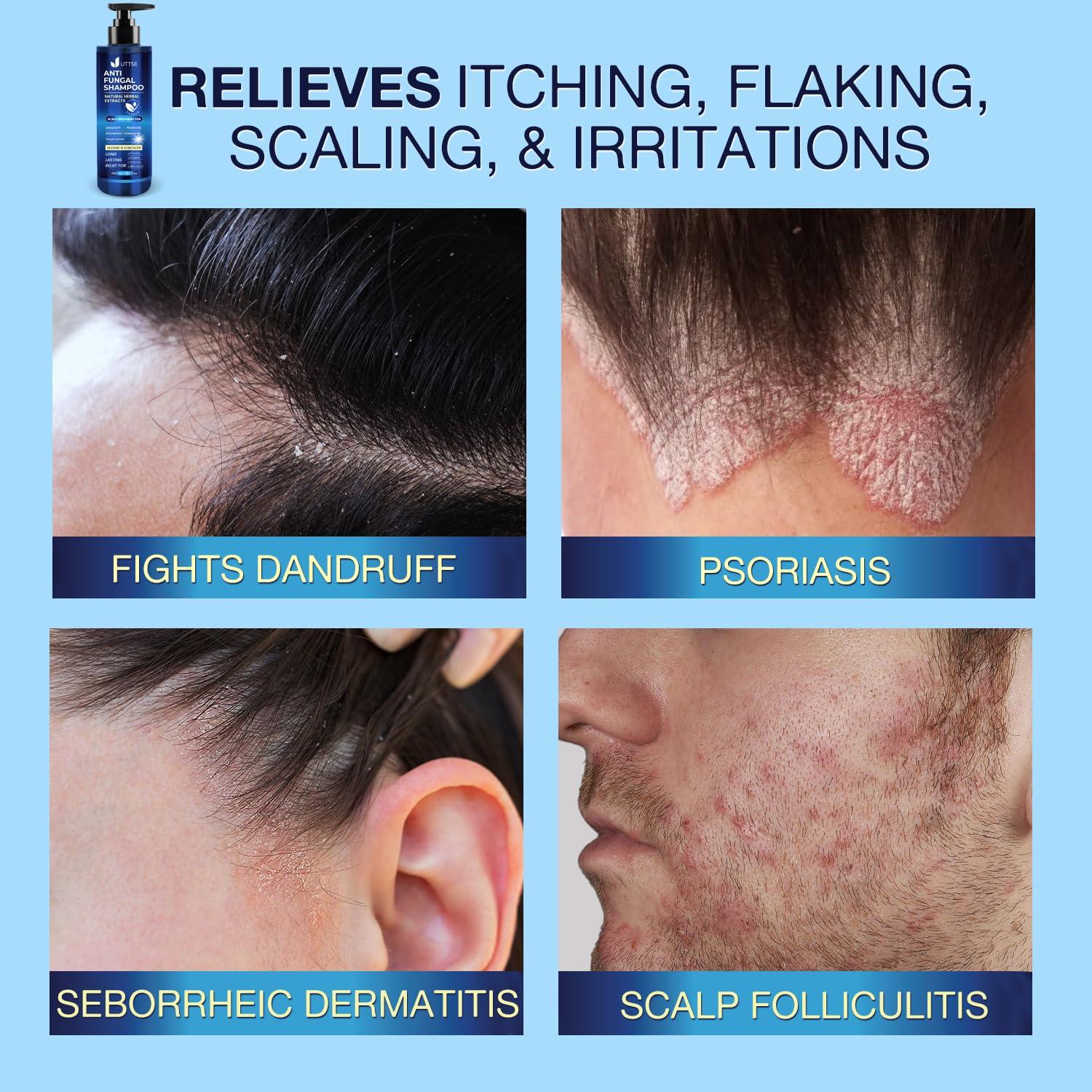 Champú Antifúngico UTTSE 300 mL para Psoriasis y Caspa