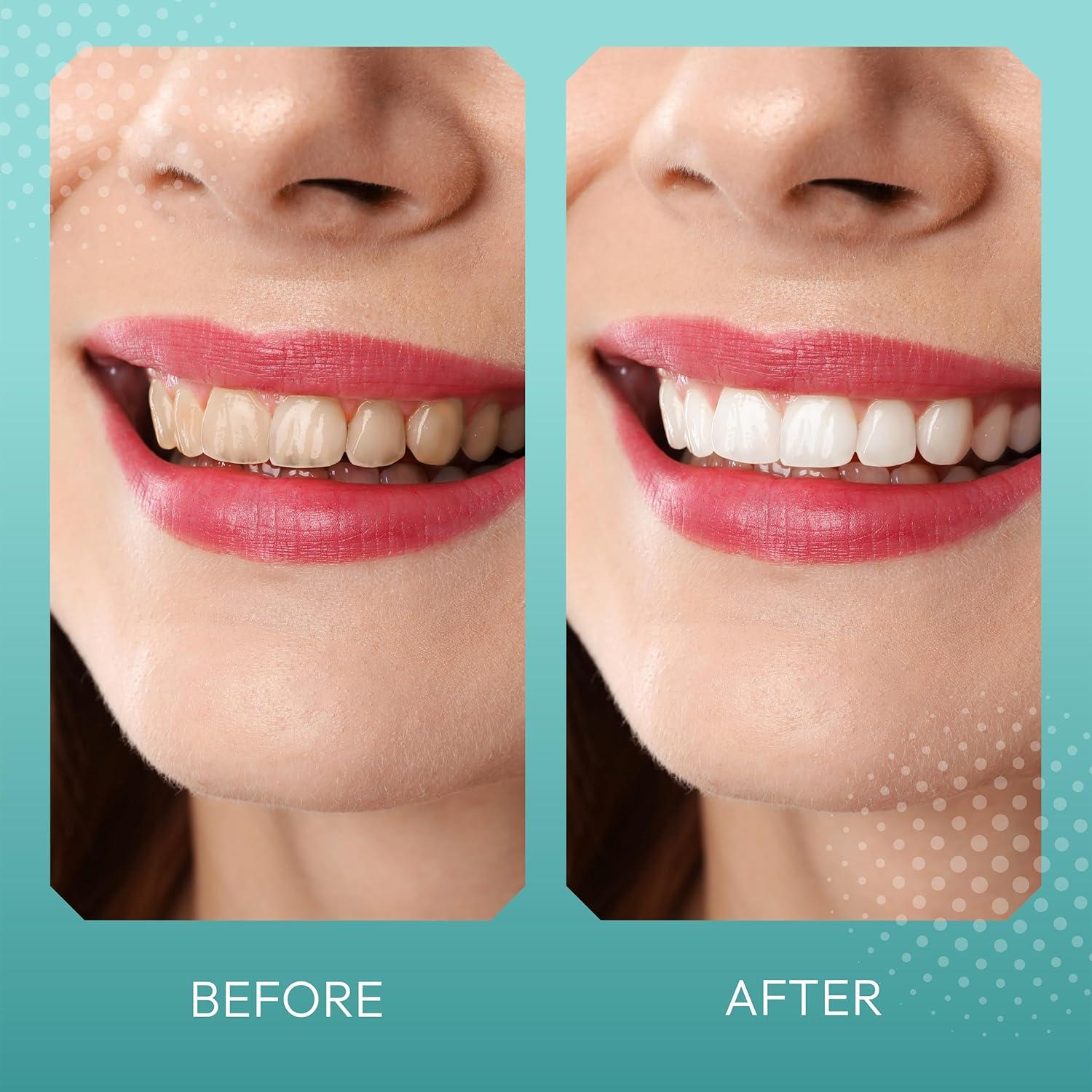 Tiras Blanqueadoras BrightTeal - 14 Tiras - Sin Peróxido