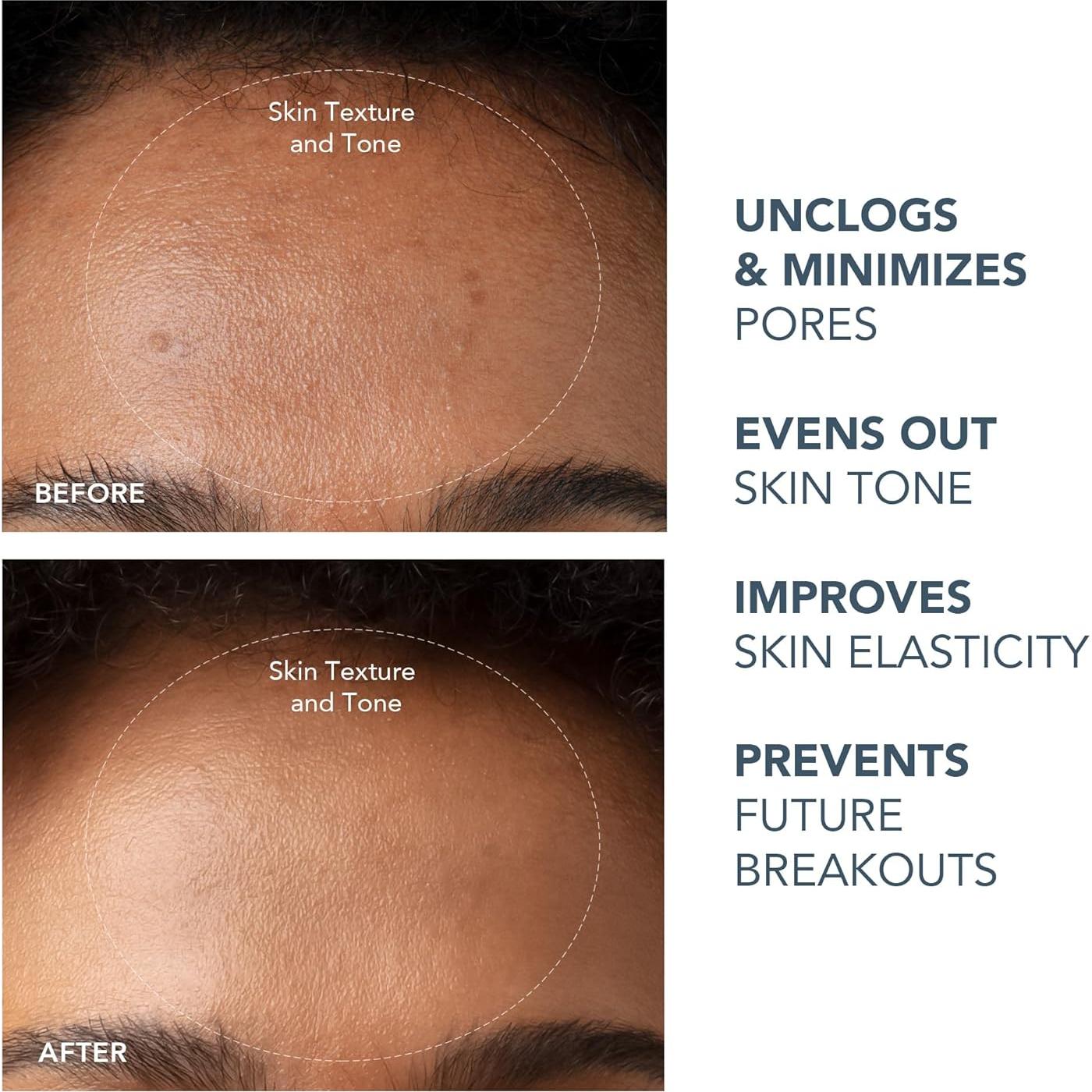 Extractor de Puntos Negros KIWI Foreo + Limpiador LUNA 2.0