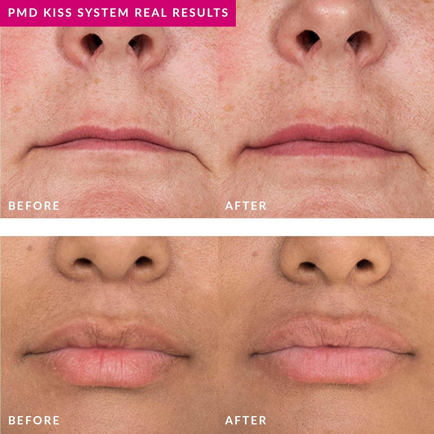 Suero Voluminizador de Labios PMD Smart 10 ml - Ácido Hialurónico