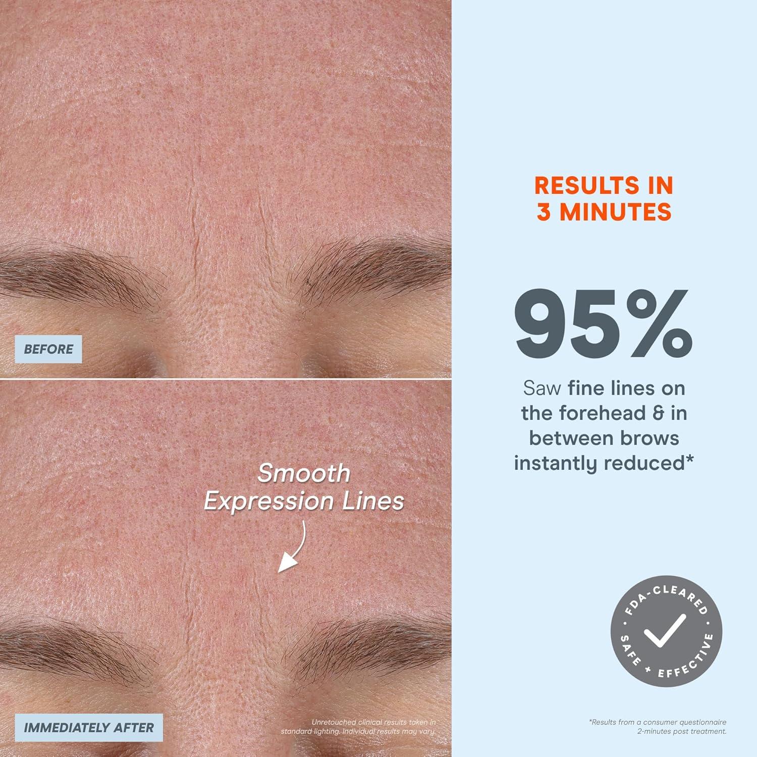 Dispositivo Facial Microcurrent NuFACE FIX Microwand - Aumento de Labios y Tratamiento para Ojos