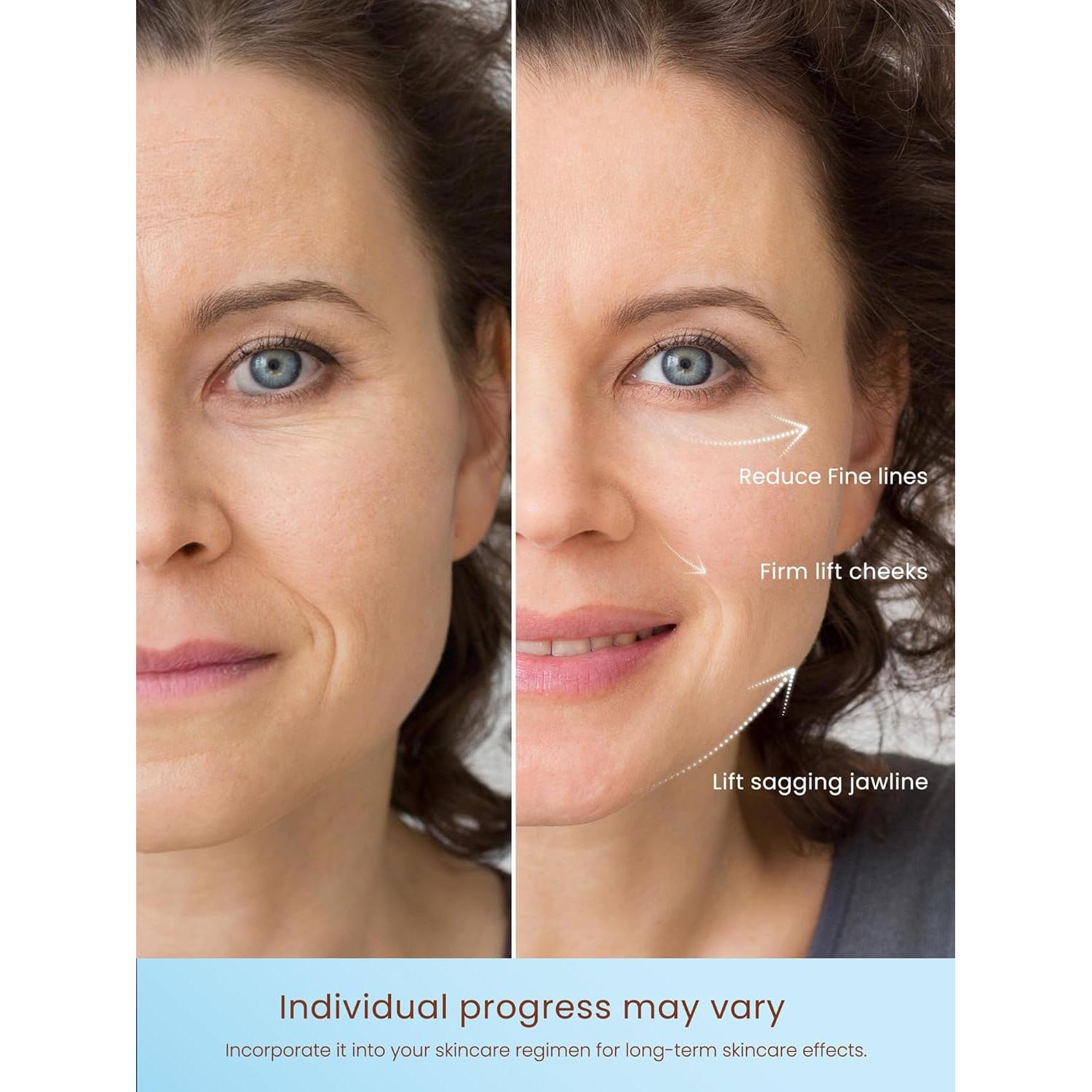 Dispositivo de Tensado de Piel RF NL04 YINGAO - 6 Modos Inteligentes