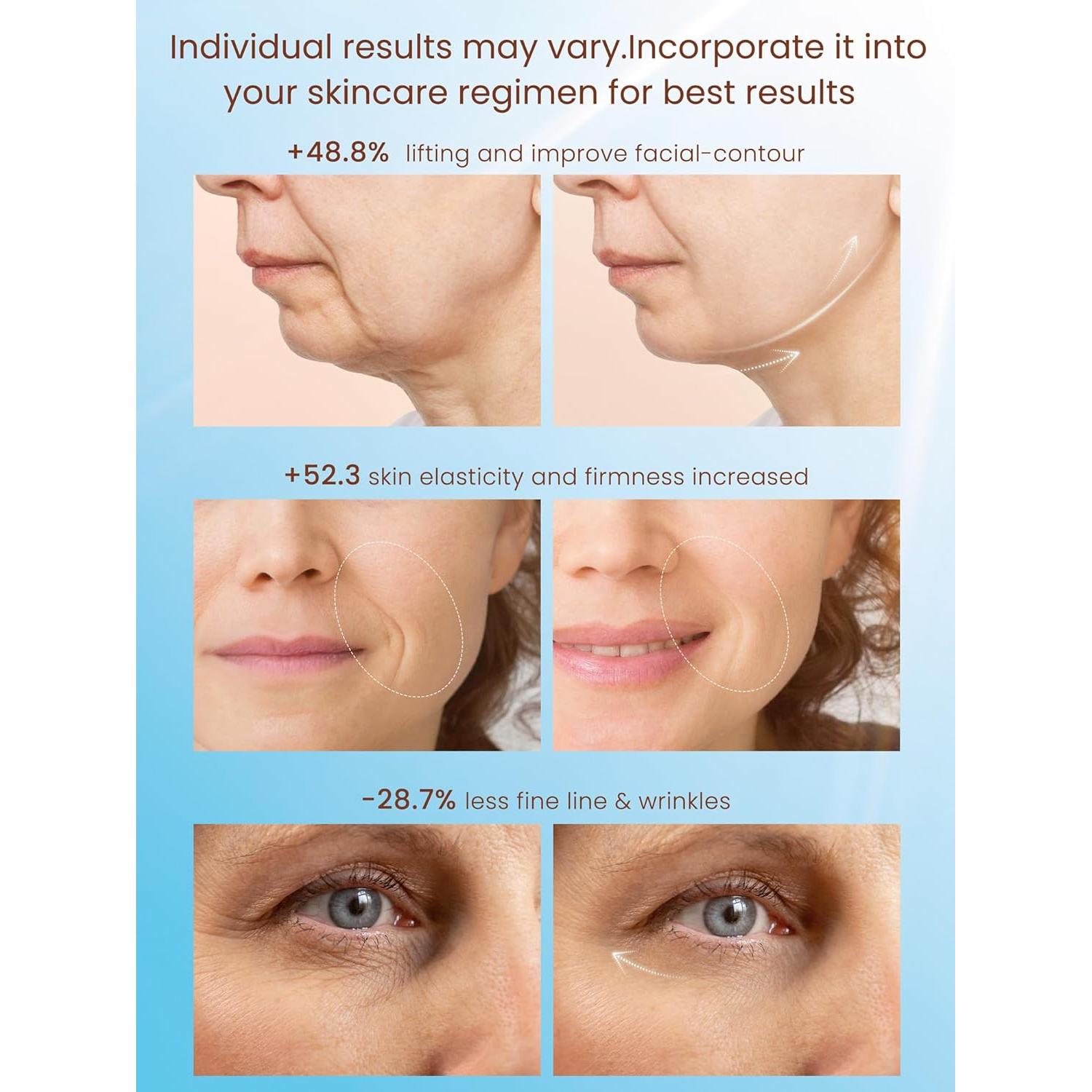 Dispositivo de Tensado de Piel RF NL04 YINGAO - 6 Modos Inteligentes