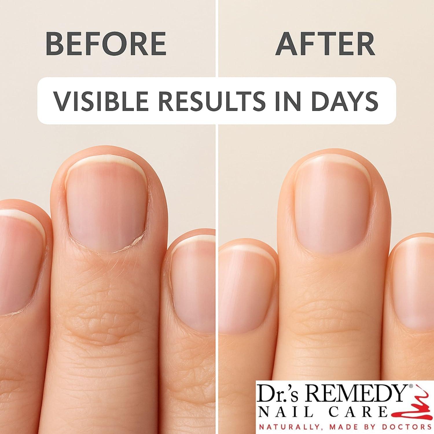 Aceite para Cutículas Terapéutico Dr's Remedy 15 ml - Nutritivo