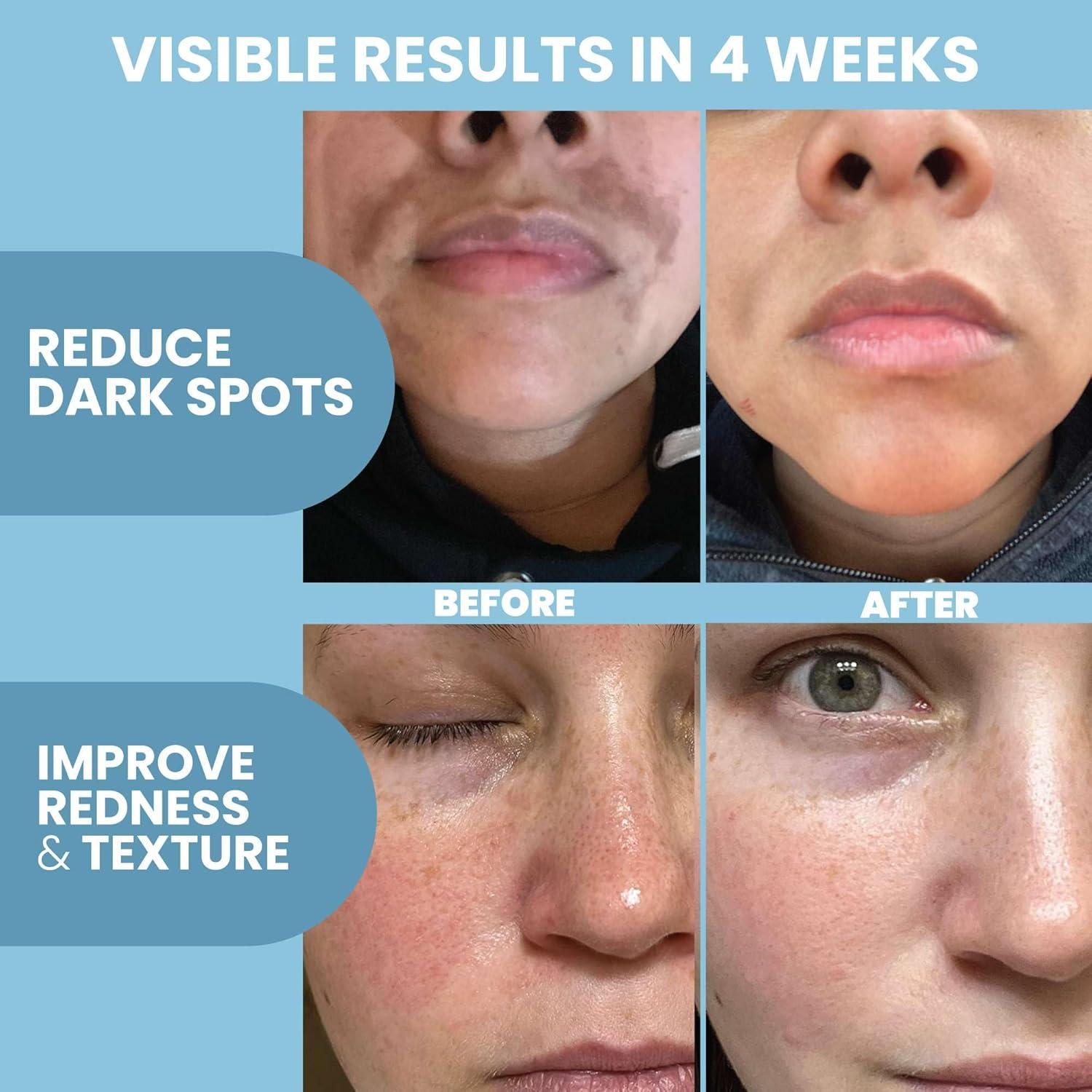 Suero Facial Eva Naturals 29.57 ml - Ácido Azelaico 10%