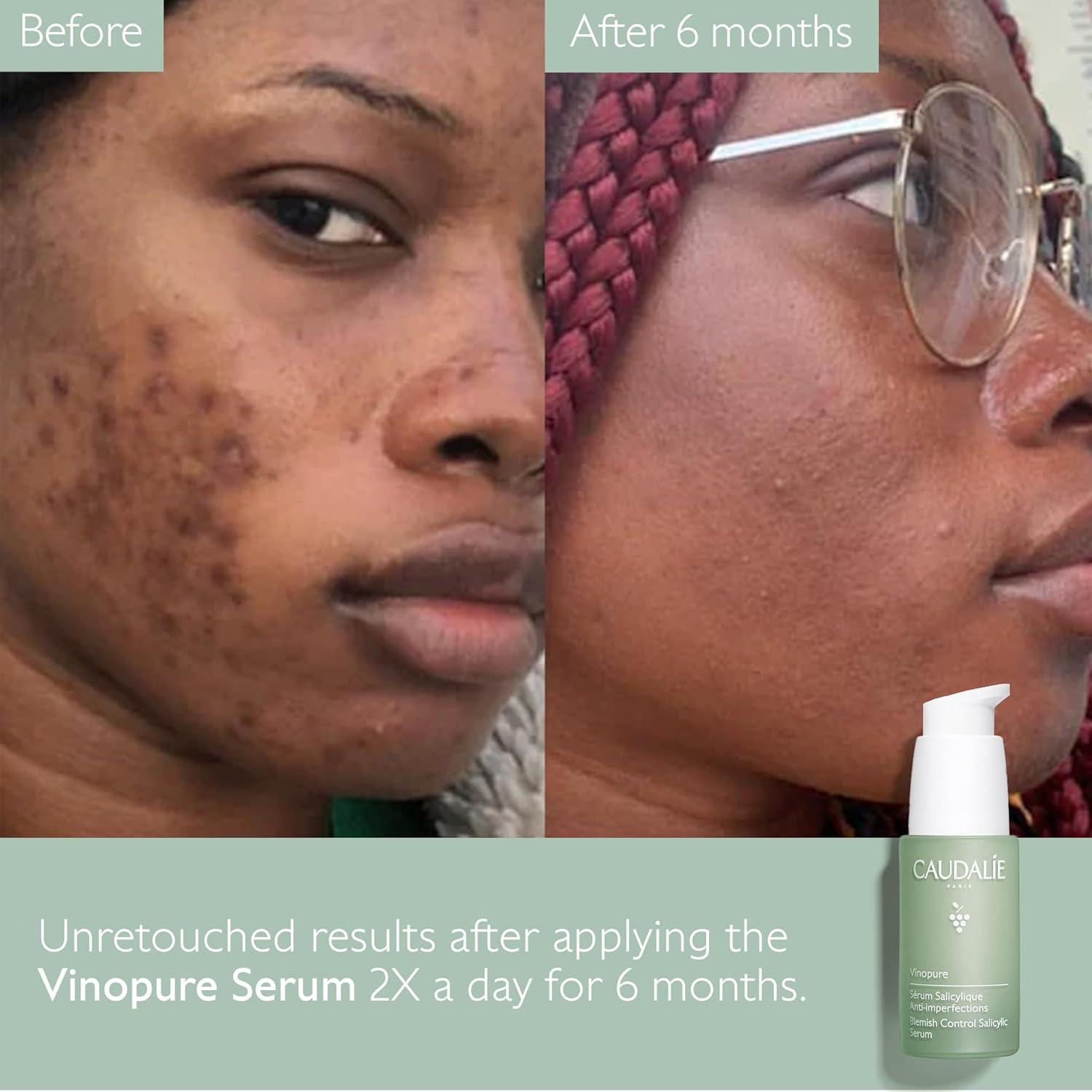 Suero Vinopure Caudalie 30 mL - Ácido Salicílico y Niacinamida