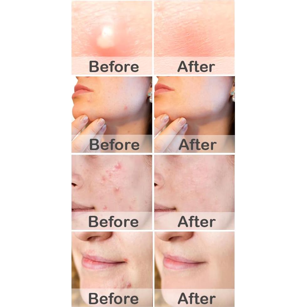 Parches para Granos MioMera - Hidrocoloide y Ácido Salicílico