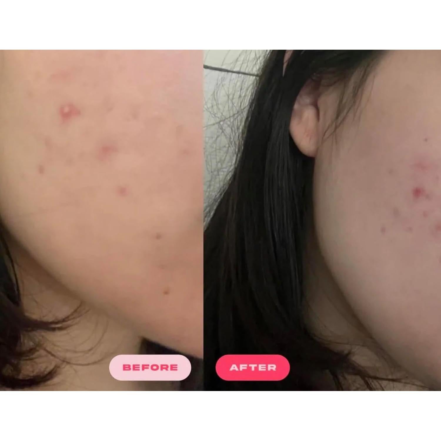 Parche Hidrocoloide Plumpie para Acné - 36 Piezas Vegano