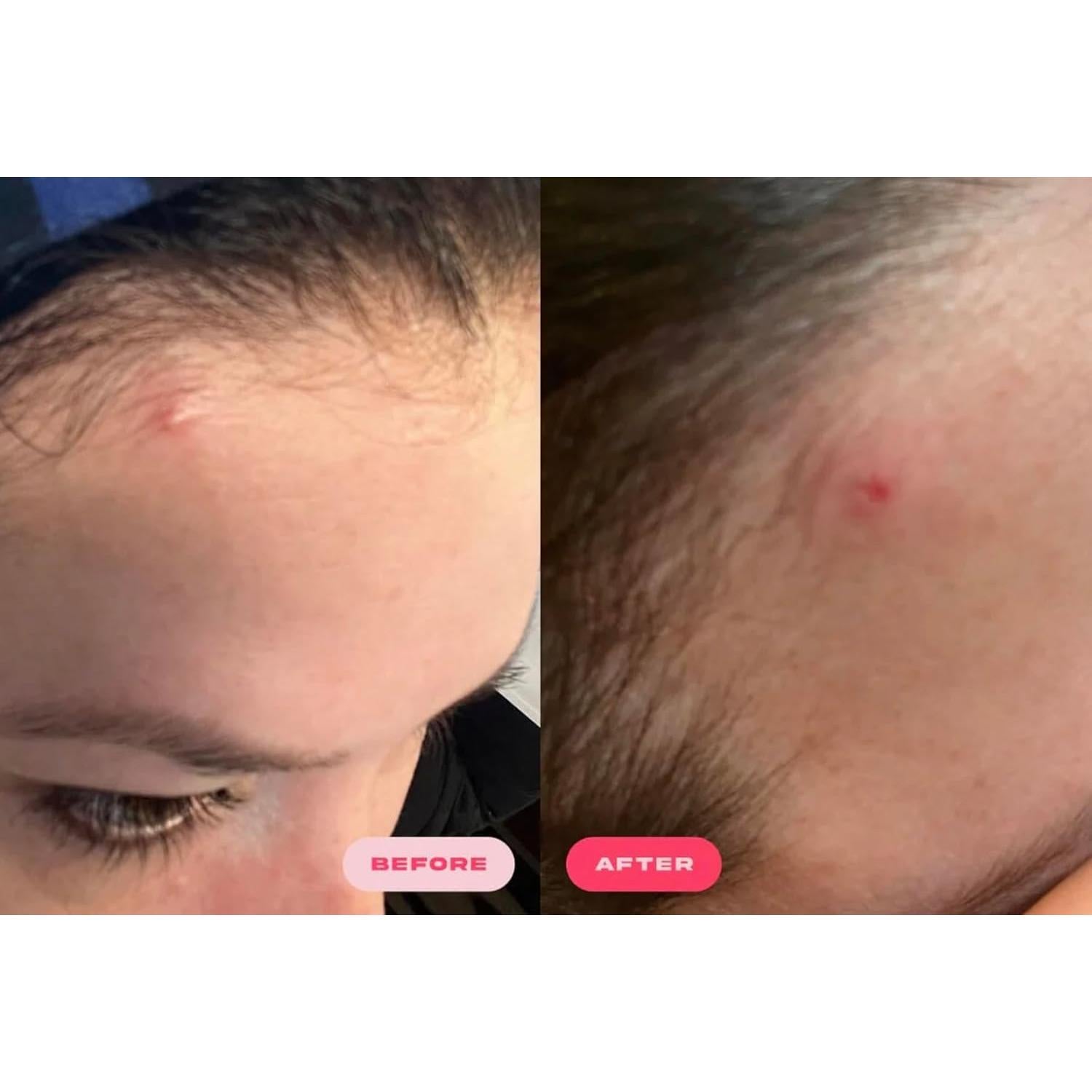 Parche Hidrocoloide Plumpie para Acné - 36 Piezas Vegano