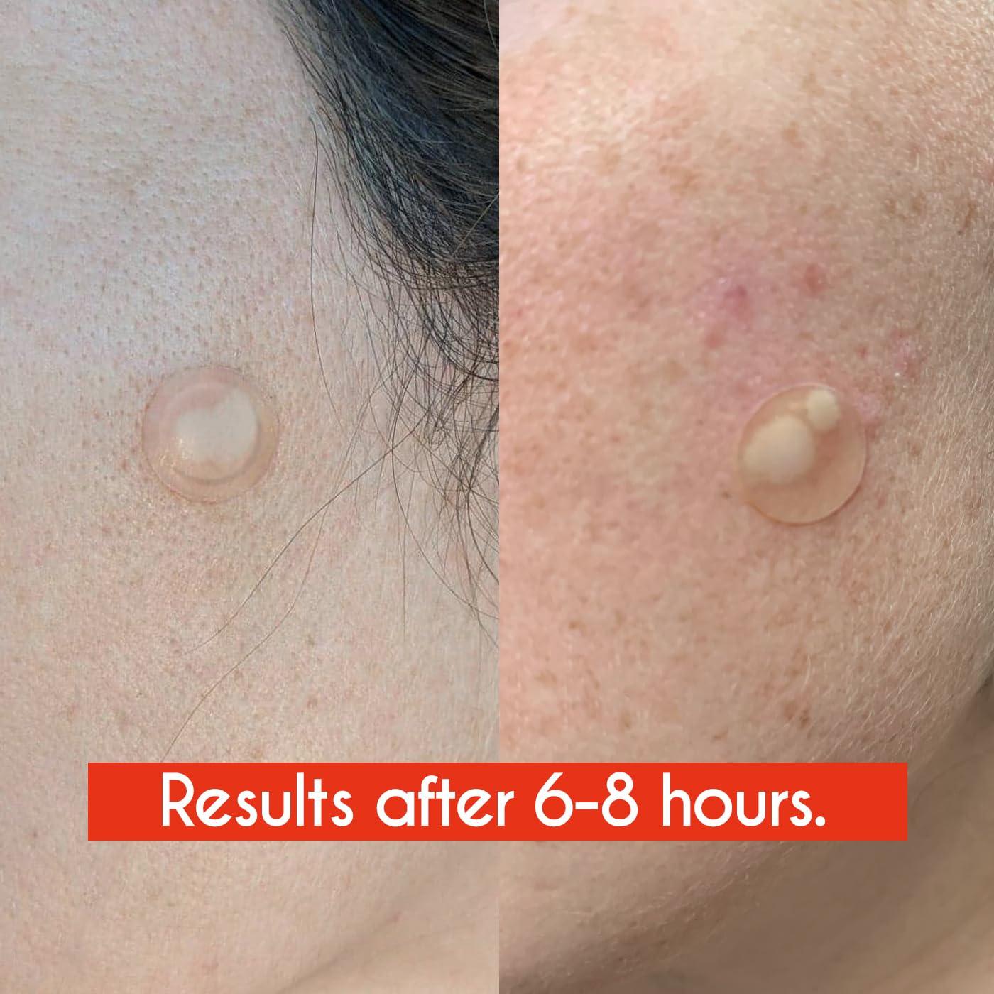 Parche Hidrocoloide para Granos ZHAOLIESM - 122 Conteos